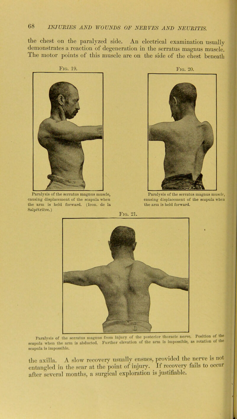 the chest on the paralyzed side. An electrical examination usually demonstrates a reaction of degeneration in the serratus magnus muscle. The motor points of this muscle are on the side of the chest beneath Fig. 19. Fig. 20. Paralysis of the serratus magnus muscle, causing displacement of the scapula when the arm is held forward. (Icon, de la Salpetriere.) Paralysis of the serratus magnus muscle, causing displacement of the scapula when the arm is held forward. Fig. 21. Paralysis of the serratus magnus from injury of the posterior thoracic nerve. Position of the scapula when the arm is abducted. Further elevation of the arm is impossible, as rotation of the scapula is impossible. the axilla. A slow recovery usually ensues, provided the nerve is not entangled in the scar at the point of injury. If recovery fails to occur after several months, a surgical exploration is justifiable.