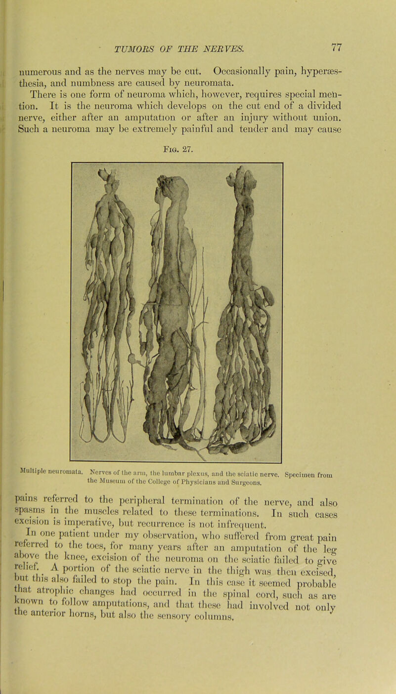 numerous and as the nerves may be cut. Occasionally pain, hyperses- tliesia, and numbness are caused by neuromata. There is one form of neuroma which, however, requires special men- tion. It is the neuroma which develops on the cut end of a divided nerve, either after an amputation or after an injury without union. Such a neuroma may be extremely painful and tender and may cause Fig. 27. Multiple neuromata. Nerves of the arm, the lumbar plexus, and the sciatic nerve. Specimen from the Museum of the College of Physicians and Surgeons. pains referred to the peripheral termination of the nerve, and also spasms in the muscles related to these terminations. In such cases excision is imperative, but recurrence is not infrequent. In one patient under my observation, who suffered from great pain referred to the toes, for many years after an amputation of the leg above the knee, excision of the neuroma on the sciatic failed to give relief.. A portion of the sciatic nerve in the thigh was then excised but this also failed to stop the pain. In this case it seemed probable that atrophic changes had occurred in the spinal cord, such as are known to follow amputations, and that these had involved not only the anterior horns, but also the sensory columns.