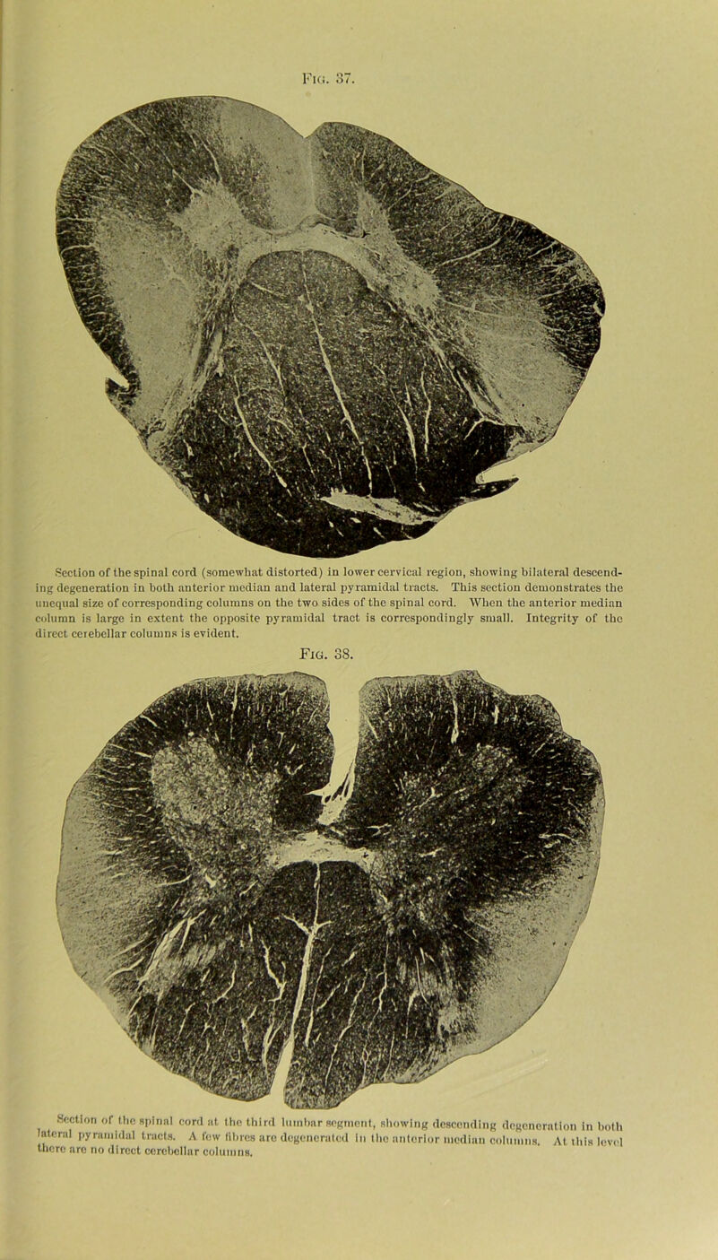 Section of the spinal cord (somewhat distorted) in lower cervical region, showing bilateral descend- ing degeneration in both anterior median and lateral pyramidal tracts. This section demonstrates the unequal size of corresponding columns on the two sides of the spinal cord. When the anterior median column is large in extent the opposite pyramidal tract is correspondingly small. Integrity of the direct cerebellar columns is evident. Fig. 38. Section of the spinal cord at the third lumbar segment, showing descending degeneration in both lateral pyramidal tracts. A few fibres are degenerated in tiro anterior median columns. At this level there are no direct cerebellar columns.