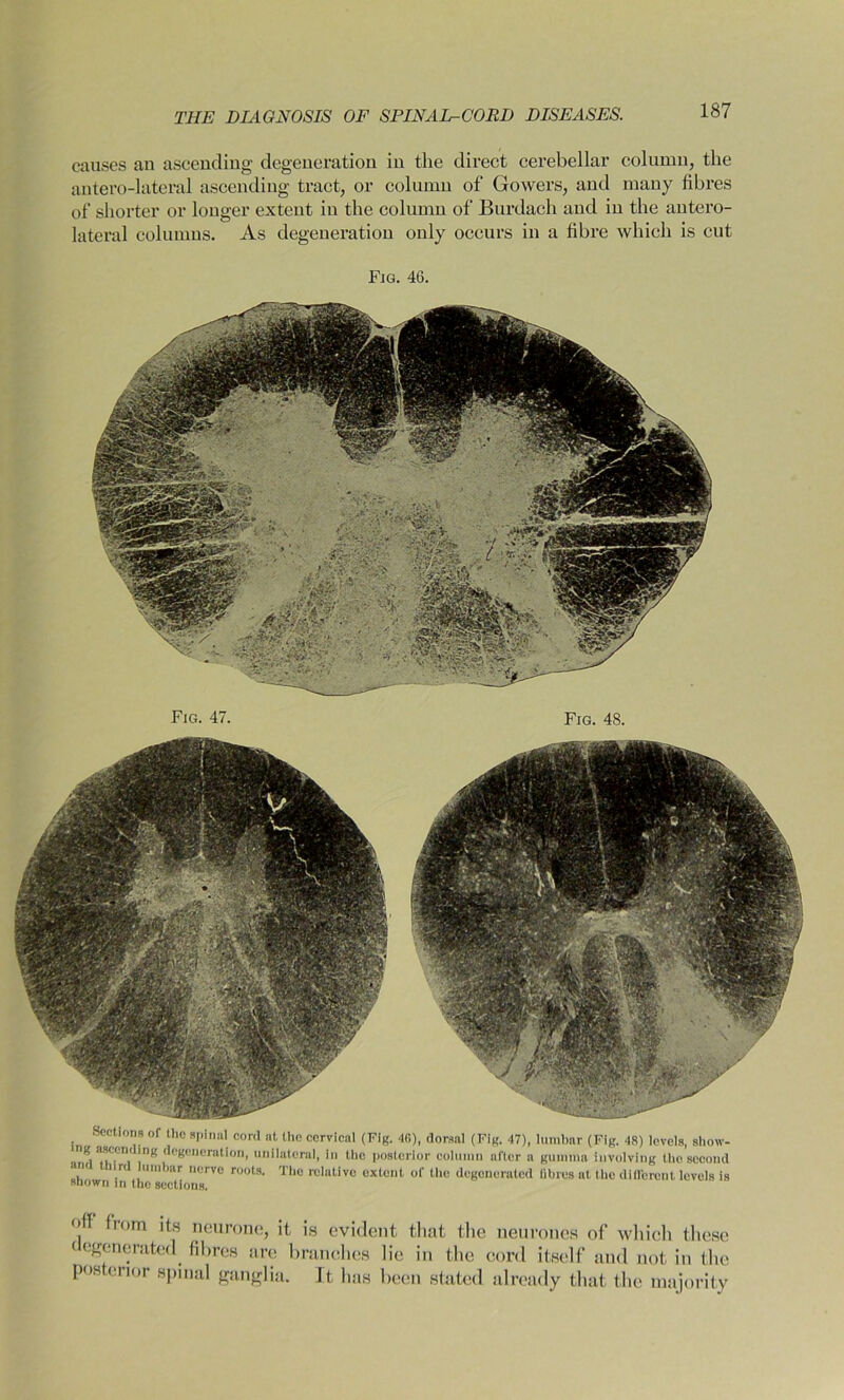 causes an ascending degeneration in the direct cerebellar column, the autero-lateral ascending tract, or column of Gowers, and many fibres of shorter or longer extent in the column of Burdach and in the antero- lateral columns. As degeneration only occurs in a fibre which is cut Fig. 46. Fig. 47. Fig. 48. Sections of the spinal cord at the cervical (Fig. 4(1), dorsal (Fig. 47), lumbar (Fig. 48) levels, show- ng asu'TKmg degeneration, unilateral, in the posterior column alter a gumma Involving the second ■u ir lumbar nerve roots. The relative extoul of the degenerated fibres at the different levels is shown in the sections. (> rom bs neurone, it is evident tliat the neurones of which these < (generated, fibres arc branches lie in the cord itself and not in the posterior spinal ganglia. It has been stated already that the majority