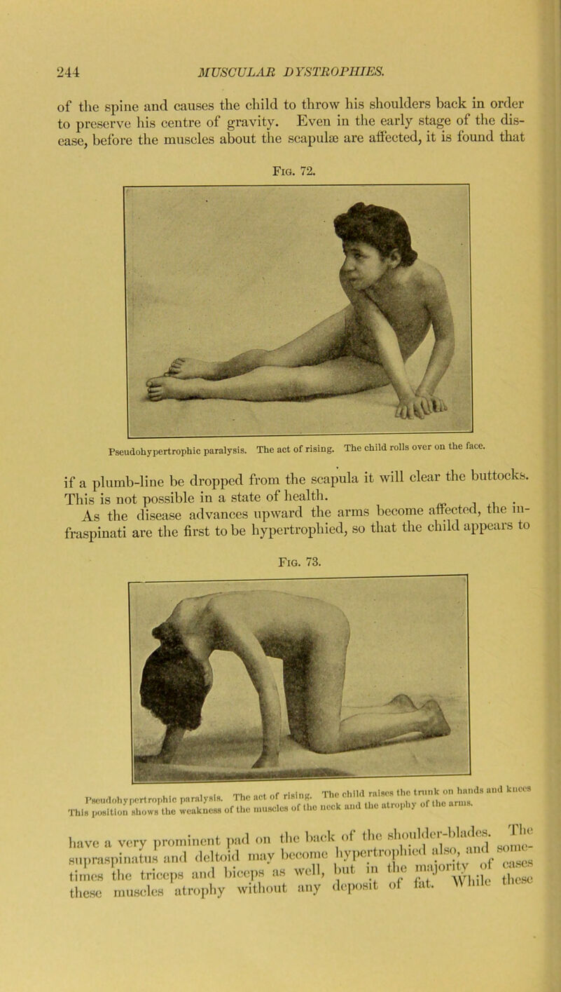 of the spine and causes the child to throw his shoulders back in order to preserve his centre of gravity. Even in the early stage of the dis- ease, before the muscles about the scapulae are affected, it is found that Fig. 72. if a plumb-line be dropped from the scapula it will clear the buttocks. This is not possible in a state of health. . As the disease advances upward the arms become affected, the m- fraspinati are the first to be hypertrophied, so that the child appears to Fig. 73. Pscudohypcrtrophlc paralysis. The act of rising. This position shows the weakness of the muscles of the The child raises the trunk on hands and knees neck and the atrophy of the arms. have a very prominent pad on the back of the should* i ^ supraspinatus and deltoid may become hypertrophied also, andf sou* times the triceps and biceps as well, but m the majonty rf cases these muscles atrophy without any deposit of fat. Wh