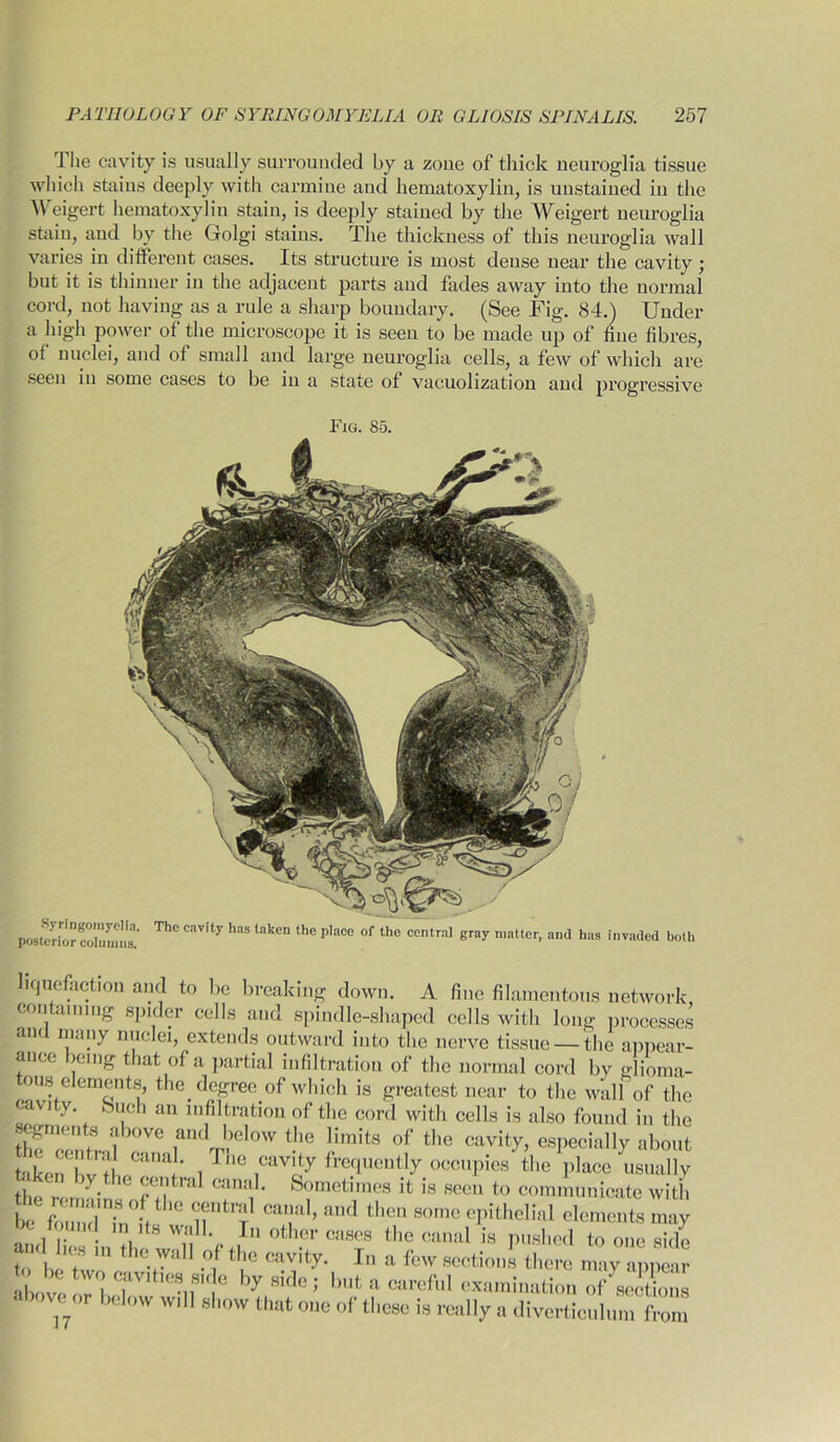 The cavity is usually surrounded by a zone of thick neuroglia tissue which stains deeply with carmine and hematoxylin, is unstained in the Weigert hematoxylin stain, is deeply stained by the Weigert neuroglia stain, and by the Golgi stains. The thickness of this neuroglia wall varies in different cases. Its structure is most dense near the cavity ; but it is thinner in the adjacent parts and fades away into the normal cord, not having as a rule a sharp boundary. (See Fig. 84.) Under a high power of the microscope it is seen to be made up of hue fibres, of nuclei, and of small and large neuroglia cells, a few of which are seen in some cases to be in a state of vacuolization and progressive Fig. 85. Syringomyelia, posterior columns. The cavity has taken the place of the central gray matter, and has invaded both liquefaction and to be breaking down. A fine filamentous network containing spider cells and spindle-shaped cells with long processes and many nuclei, extends outward into the nerve tissue —the appear- ance being that of a partial infiltration of the normal cord by ajioma- tous elements, the degree of which is greatest near to the wall of the cavity buch an infiltration of the cord with cells is also found in the segments above and below the limits of the cavity, especially about take wl Ca,,al- ,The ™vity frequently occupies the place usually token by the central canal. Sometimes it is seen to communicate with the lema'ns of the central canal, and then some epithelial elements may ^ found mils wall In other eases the canal is pushed to one side and hes m the wall of the cavity. In a few section! there may apttir '.I ovc !,r! ?V,t™ SK c hy a careful examination of sc, lions above or below wdl show that one of these is really a diverticulum from