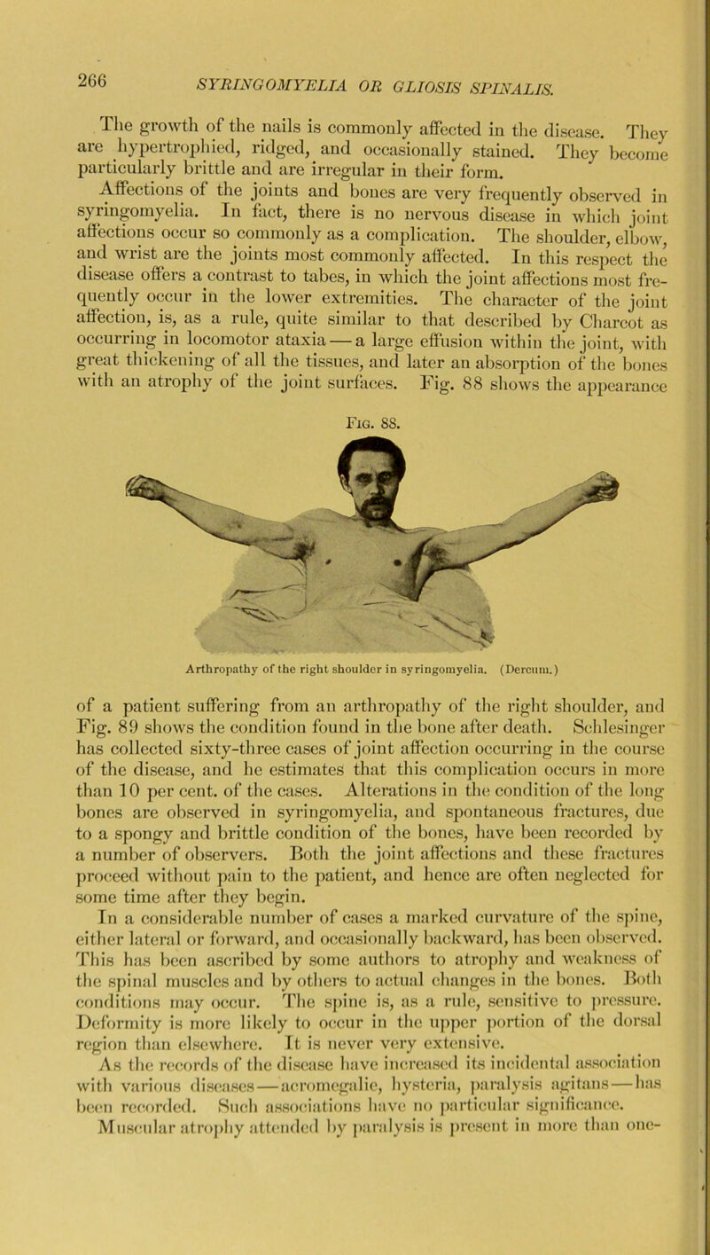The growth of the nails is commonly affected in the disease. They are hypertrophied, ridged, and occasionally stained. They become particularly brittle and are irregular in their form. Affections of the joints and bones are very frequently observed in syringomyelia. In fact, there is no nervous disease in which joint affections occur so commonly as a complication. The shoulder, elbow, and wiist are the joints most commonly affected. In this respect the disease offers a contrast to tabes, in which the joint affections most fre- quently occur in the lower extremities. The character of the joint affection, is, as a rule, quite similar to that described by Charcot as occurring in locomotor ataxia — a large effusion within the joint, with great thickening of all the tissues, and later an absorption of the bones with an atrophy of the joint surfaces. Fig. 88 shows the appearance Fig. SS. Arthropathy of the right shoulder in syringomyelia. (Dercum.) of a patient suffering from an arthropathy of the right shoulder, and Fig. 89 shows the condition found in the bone after death. Schlesingcr has collected sixty-three cases of joint affection occurring in the course of the disease, and he estimates that this complication occurs in more than 10 per cent, of the cases. Alterations in the condition of the long bones are observed in syringomyelia, and spontaneous fractures, due to a spongy and brittle condition of the bones, have been recorded by a number of observers. Both the joint affections and these fractures proceed without pain to the patient, and hence are often neglected for some time after they begin. In a considerable number of cases a marked curvature of the spine, cither lateral or forward, and occasionally backward, has been observed. This has been ascribed by some authors to atrophy and weakness of the spinal muscles and by others to actual changes in the bones. Botli conditions may occur. The spine is, as a rule, sensitive to pressure. Deformity is more likely to occur in the upper portion of the dorsal region than elsewhere. It is never very extensive. As the records of the disease have increased its incidental association with various diseases—acromegalic, hysteria, paralysis agitans—has been recorded. Such associations have no particular significance. M useular atrophy attended by paralysis is present in more than one-