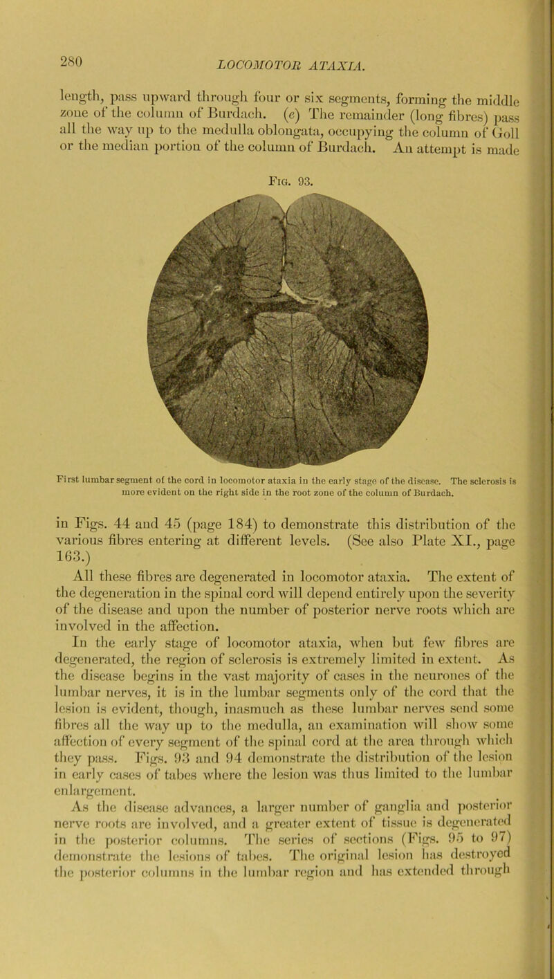 2S0 length, pass upward through four or six segments, forming the middle zone of the column of Burdach. (e) The remainder (long fibres) pass all the way up to the medulla oblongata, occupying the column of Goll or the median portion of the column of Burdach. An attempt is made Fig. 93. First lumbar segment of the cord in locomotor ataxia in the early stage of the disease. The sclerosis is more evident on the right side in the root zone of the column of Burdach. in Figs. 44 and 45 (page 184) to demonstrate this distribution of the various fibres entering at different levels. (See also Plate XI., page 163.) All these fibres are degenerated in locomotor ataxia. The extent of the degeneration in the spinal cord will depend entirely upon the severity of the disease and upon the number of posterior nerve roots which are involved in the affection. In the early stage of locomotor ataxia, when but few fibres are degenerated, the region of sclerosis is extremely limited in extent. As the disease begins in the vast majority of cases in the neurones of the lumbar nerves, it is in the lumbar segments only of the cord that the lesion is evident, though, inasmuch as these lumbar nerves send some fibres all the way up to the medulla, an examination will show some affection of every segment of the spinal cord at the area through which they pass. Figs. 93 and 94 demonstrate the distribution of the lesion in early cases of tabes where the lesion was thus limited to the lumbar enlargement. As the disease advances, a larger number of ganglia and posterior nerve roots are involved, and a greater extent of tissue is degenerated in the posterior columns. The series of sections (Figs. 95 to 97) demonstrate the lesions of tabes. The original lesion has destroyed the posterior columns in the lumbar region and has extended through