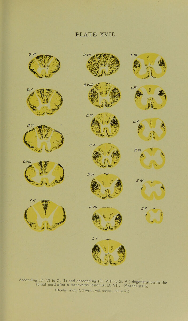 Ascending iD. VI to C. II) and descending (D. VIII to S. V.) degeneration spinal cord after a transverse lesion at D. VII. Marchi stain. in the (II on he, Arch. f. Psych., vol. xxviii,, plate ix.)