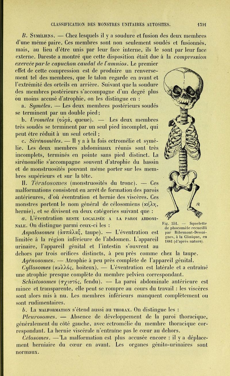 la compression B. Syméliens. — Chez lesquels il y a soudure et fusion des deux membres d’une même paire. Ces membres sont non seulement soudés et fusionnés, mais, au lieu d’être unis par leur face interne, ils le sont par leur face externe. Dareste a montré que cette disposition était due exercée par le capuchon caudal de ïamnios. Le premier effet de cette compression est de produire un renverse- ment tel des membres, que le talon regarde en avant et l’extrémité des orteils en arrière. Suivant que la soudure des membres postérieurs s’accompagne d’un degré plus ou moins accusé d’atrophie, on les distingue en : a. Symèles. — Les deux membres postérieurs soudés se terminent par un double pied; b. Uromèles (oùpà, queue). — Les deux membres très soudés se terminent par un seul pied incomplet, qui peut être réduit à un seul orteil ; c. Sirénornèles. — Il y a à la fois ectromélie et symé- lie. Les deux membres abdominaux réunis sont très incomplets, terminés en pointe sans pied distinct. La sirénomélie s’accompagne souvent d’atrophie du bassin et de monstruosités pouvant même porter sur les mem- bres supérieurs et sur la tête. IL Tératosomes (monstruosités du tronc). — Ces malformations consistent en arrêt de formation des parois antérieures, d’où éventration et hernie des viscères. Ces monstres portent le nom général de célosomiens (xyJXtj, hernie), et se divisent en deux catégories suivant que : a. L’éventration reste localisée a la paroi abdomi- nale. On distingue parmi ceux-ci les : Aspalosomes (ào-TràXaÇ, taupe). — L’éventration est limitée à la région inférieure de l’abdomen. L’appareil urinaire, l’appareil génital et l’intestin s’ouvrent au dehors par trois orifices distincts, à peu près comme chez la taupe. Agénosomes. — Atrophie à peu près complète de l’appareil génital. Cijllosomes (xtAXoç, boiteux). — L’éventration est latérale et a entraîné une atrophie presque complète du membre pelvien correspondant. Schistosomes (o-^lo-toç, fendu). — La paroi abdominale antérieure est mince et transparente, elle peut se rompre au cours du travail : les viscères sont alors mis à nu. Les membres inférieurs manquent complètement ou sont rudimentaires. b. La malformation s’étend aussi au thorax. On distingue les : Pleurosomes. — Absence de développement de la paroi thoracique, généralement du côté gauche, avec ectromélie du membre thoracique cor- respondant. La hernie viscérale n’entraine pas le cœur au dehors. Célosomes. — La malformation est plus accusée encore : il y a déplace- ment herniaire du cœur en avant. Les organes génito-urinaires sont normaux. Fig. 551. — Squelette de phocomèle recueilli par Ribemont-Dessai- gnes, à la Clinique, en 1881 (d’après nature).