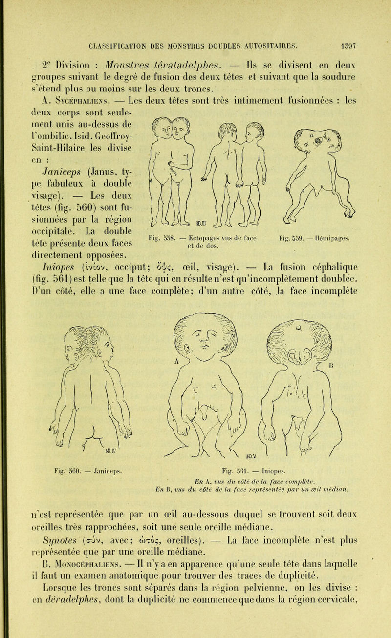 2e Division : Monstres tératadelphes. — Ils se divisent en deux groupes suivant le degré de fusion des deux têtes et suivant que la soudure s’étend plus ou moins sur les deux troncs. A. SycéphalielNS. — Les deux têtes sont très intimement fusionnées : les deux corps sont seule- ment unis au-dessus de l’ombilic. Isid. Geoffroy-- Saint-Hilaire les divise en : Janiceps (Janus, ty- pe fabuleux à double visage). — Les deux têtes (fig. 560) sont fu- sionnées par la région occipitale. La double tète présente deux faces directement opposées. Iniopes (tvtov, occiput; o^ç, œil, visage). — La fusion céphalique (fig. 561) est telle que la tête qui en résulte n’est qu’incomplètement doublée. D’un côté, elle a une face complète; d’un autre côté, la face incomplète 558. — Ectopages vus de face et de dos. Fig. 559. — Hémipages. Fig.' 560. — Janiceps. Fig. 561. — Iniopes. En À, vus du-côté de la face complète. En B, vus du côté de la face représentée par un œil médian. n’est représentée que par un œil au-dessous duquel se trouvent soit deux oreilles très rapprochées, soit une seule oreille médiane. Synotes (<juv, avec; wtoç, oreilles). — La face incomplète n’est plus représentée que par une oreille médiane. B. Monocéphaliens. —Il n’y a en apparence qu’une seule tête dans laquelle il faut un examen anatomique pour trouver des traces de duplicité. Lorsque les troncs sont séparés dans la région pelvienne, on les divise : en déradelphes, dont la duplicité ne commence que dans la région cervicale.
