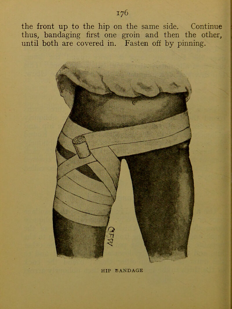 thus, bandaging first one groin and then the other, until both are covered in. Fasten off by pinning.