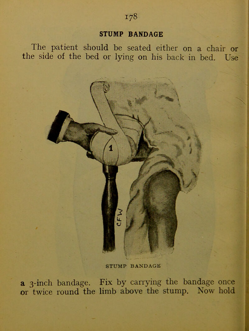 STUMP BANDAGE The patient should be seated either on a chair or the side of the bed or lying on his back in bed. Use STUMP BANDAGE a 3-inch bandage. Fix by carrying the bandage once or twice round the limb above the stump. Now hold
