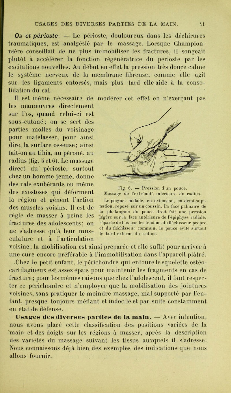 Os et périoste. — Le périoste, douloureux dans les déchirures traumatiques, est analgésié par le massage. Lorsque Champion- mère conseillait de ne plus immobiliser les fractures, il songeait plutôt à accélérer la fonction régénératrice du périoste par les excitations nouvelles. Au début en effet la pression très douce calme le système nerveux de la membrane fibreuse, comme elle agit sur les ligaments entorsés, mais plus tard elle aide à la conso- lidation du cal. 11 est même nécessaire de modérer cet effet en n’exerçant pas les manœuvres directement sur Los, quand celui-ci est sous-cutané; on se sert des parties molles du voisinage pour matelasser, pour ainsi dire, la surface osseuse ; ainsi fait-on au tibia, au péroné, au radius (fig. 5 et 6). Le massage direct du’ périoste, surtout chez un homme jeune, donne des cals exubérants ou même des exostoses qui déforment la région et gênent faction des muscles voisins. Il est de règle de masser à peine les fractures des adolescents; on ne s’adresse qu’à leur mus- culature et à l’articulation voisine; la mobilisation est ainsi préparée et elle suffit pour arriver à une cure encore préférable à l’immobilisation dans l’appareil plâtré. Chez le petit enfant, le périchondre qui entoure le squelette ostéo- cartilagineux est assez épais pour maintenir les fragments en cas de fracture ; pour les mêmes raisons que chez l’adolescent, il faut respec- ter ce périchondre et n’employer que la mobilisation des jointures voisines, sans pratiquer le moindre massage, mal supporté par l’en- fant, presque toujours méfiant et indocile et par suite constamment en état de défense. Usajçes des diverses parties de la main. — Avec intention, nous avons placé cette classification des positions variées de la main et des doigts sur les régions à masser, après la description des variétés du massage suivant les tissus auxquels il s’adresse. Nous connaissons déjà bien des exemples des indications que nous allons fournir. Fig. 6. — Pression d'un pouce. Massage de l’extrémilé inférieure du radius. Le poignet malade, en extension, en demi-supi- nation, repose sur un coussin. La face palmaire de la phalangine du pouce droit fait une pression légère sur la face antérieure de l’épiphyse radiale, séparée de l’os par les tendons du fléchisseur propre et du fléchisseur commun, le pouce évite surtout le bord externe du radius.