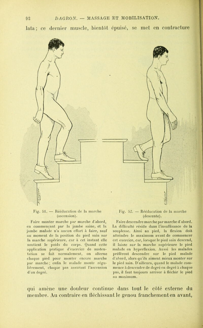 lata; ce dernier muscle, Lientùt épuisé, se met en contracture %w.' Fig. 51. — Rééducaüou de la marche (ascension). Faire monter marche par marche d’abord, en commençant par la jambe saine, et la jambe malade n’a aucun efl'ort A faire, sauf au moment de la jmsition du pied sain sur la marche supérieure, car cet instant elle soutient le poids du corps. Quand cette apj)lication j)ratic]uc d’exercice de susten- tation se fait normalement, on alterne chaque pied ])Our monter encore marche ]>ar marche; enfin le malade monte régu- lièrement, chaque pas assurant l’ascension d'un degré. Fig. 52. — Rééducation de la marche (descente). Faire descendre marche par marche d’abord. La difficulté réside dans l’insuffisance de la souplesse. Ainsi au jiied, la llexion doit atteindre le maximum avant de commencer cet exercice, car, lorsque le pied sain descend, il laisse sur la marche supérieure le pied malade en hyperllexion. Aussi les malades préfèrent descendre sur le pied malade d’abord, alors qu’ils aiment mieux monter sur le pied sain. D’ailleurs, quand le malade com- mence <à descendre de degré en degré à chaque pas, il faut toujours arriver à fléchir le 2>ied au maximum. qui amène une doiilour continue dans tout le côté externe du membre. Au contraire en tlécliissant le genou franchement en avant.