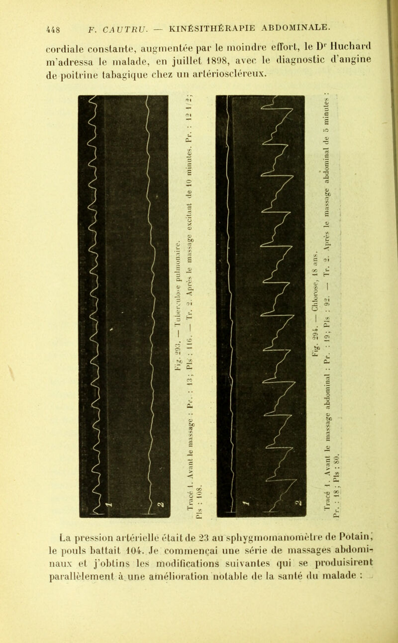 cordiale constante, augmentée par le moindre effort, le D‘ Huchard m’adressa le malade, en juillet 1898, avec le diagnostic d angine de poitrine tabagique chez iiii arlérioscléreu.x. La pression aidériellé était de 23 au spliygmomanomèti e de Potain,' le pouls battait 104. Je commençai une série de massages abdomi-; naux et j’obtins les modifications suivantes (jui se produisirent parallèlement à.une amélioration notable de la santé du malade : .