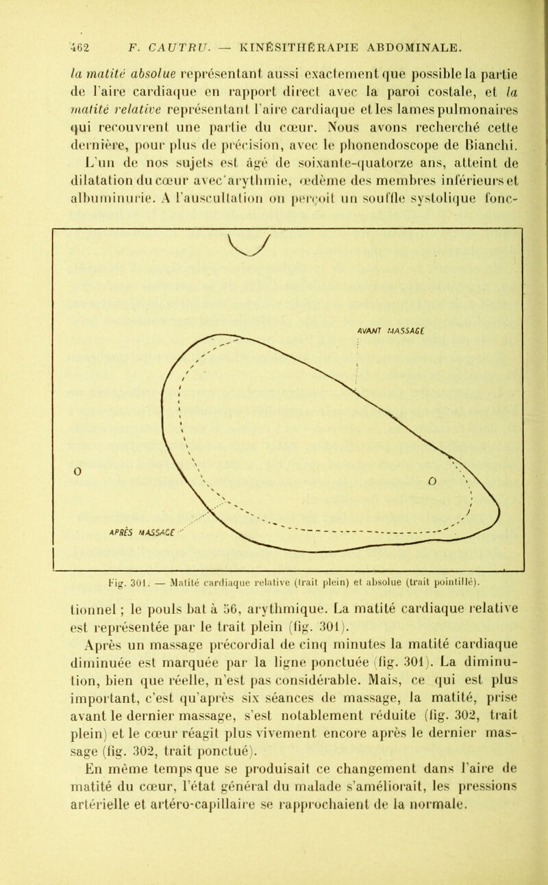 la matité absolue représentant aussi exactement que possible la partie de Faire cardiaque en rapport direct avec la paroi costale, et la matité relative représentant Faire cardiaque et les lames pulmonaires qui recouvrent une partie du cœur. Nous avons recherché cette dernière, pour plus de précision, avec le phonendoscope de Bianchi. L’un de nos sujets est âgé de soixante-(iuatorze ans, atteint de dilatation du cœur avec'arytiimie, œdème des membres intérieurs et albuminui-ie. A Fauscullalion on [)ercoit un souttle systolique tonc- tionnel ; le pouls bat à 56, arythmique. La matité cardiaque relative est représentée par le trait plein (tig. 301). Après un massage précordial de cinq minutes la matité cardiaque diminuée est marquée par la ligne ponctuée fig. 301 j. La diminu- tion, bien que réelle, n’est pas considérable. Mais, ce qui est plus important, c’est qu’après six séances de massage, la matité, prise avant le dernier massage, s’est notablement réduite (tig. 302, trait plein) et le cœur réagit plus vivement encore après le dernier mas- sage (Fig. 302, trait ponctué). En même temps que se produisait ce changement dans Faire de matité du cœur, l’état général du malade s’améliorait, les pressions artérielle et artéro-capillaire se rapprochaient de la normale.