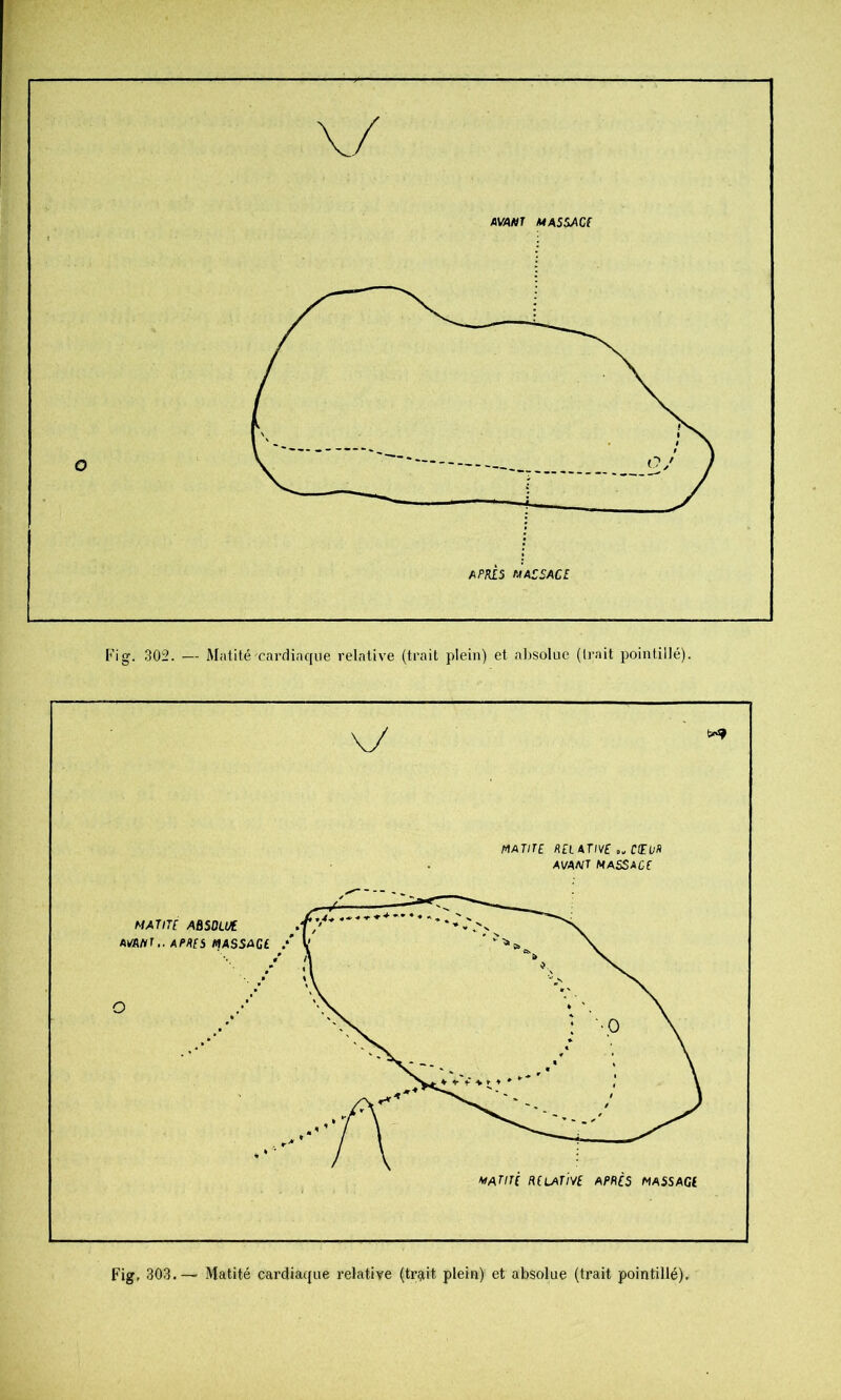 V/ AVAHr MASSAC( Fig. 302. — Matité cardiaque relative (trait plein) et al)SoIue (Irait pointillé). Fig, 303.— Matité cardiaque relative (trçiit plein) et absolue (trait pointillé).