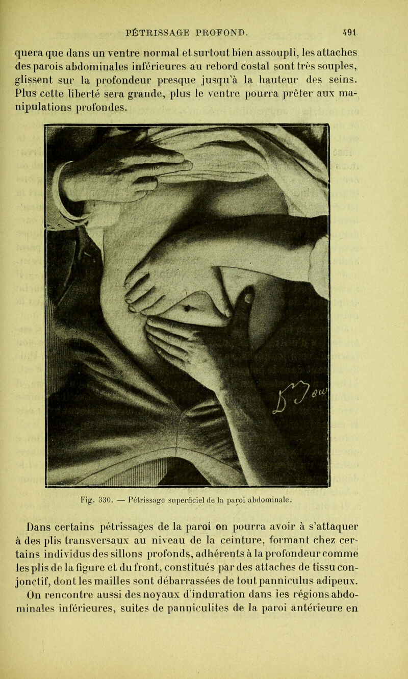 quera que dans un ventre normal et surtout bien assoupli, les attaches des parois abdominales inférieures au rebord costal sont très souples, glissent sur la profondeur presque jusqu’à la hauteur des seins. Plus cette liberté sera grande, plus le ventre pourra prêter aux ma- nipulations profondes. Fig. 330. — Pétrissage superficiel de la paroi abdominale. Dans certains pétrissages de la paroi on pourra avoir à s’attaquer à des plis transversaux au niveau de la ceinture, formant chez cer- tains individus des sillons profonds, adhérents à la profondeur comme les plis de la figure et du front, constitués par des attaches de tissu con- jonctif, dont les mailles sont débarrassées de toutpanniculus adipeux. On rencontre aussi des noyaux d’induration dans les régions abdo- minales inférieures, suites de panniculites de la paroi antérieure en