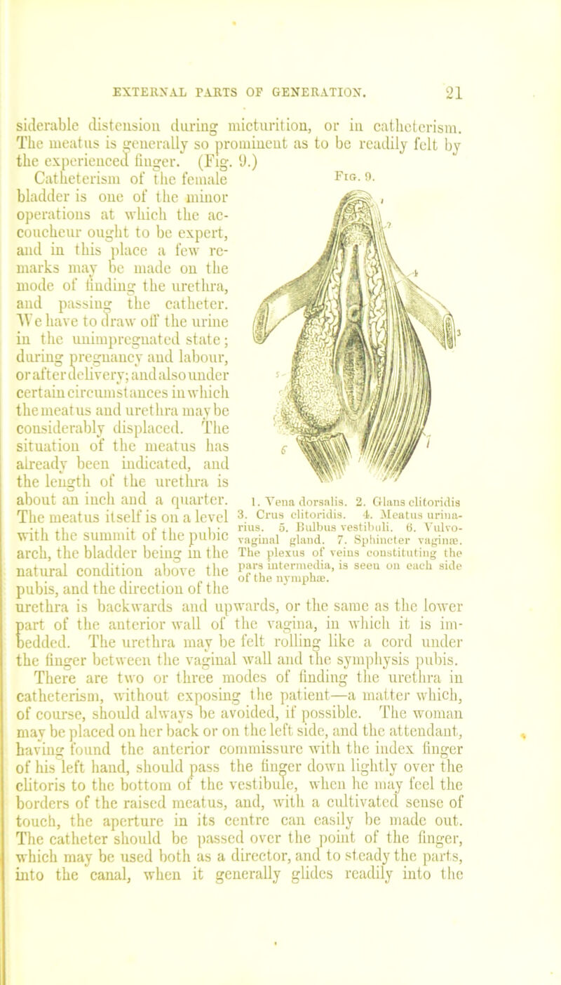 siderable distension during micturition, or in catlieterism. The meatus is generally so prominent as to be readily felt by the experienced finger. (Fig. 9.) Catneterism of the female Fig- n- bladder is one of the minor operations at which the ac- coucheur ought to be expert, and in this place a few re- marks may be made on the mode of finding the urethra, and passing the catheter. We have to draw off the urine in the unimpregnated state; during pregnancy and labour, or after delivery; and also under certain circumstances in which themeatus and urethra maybe considerably displaced. The situation of the meatus has already been indicated, and the length of the urethra is about an inch and a quarter. The meatus itself is on a level with the summit of the pubic arch, the bladder being in the natural condition above the pubis, and the direction of the urethra is backwards and upwards, or the same as the lower part of the anterior wall of the vagina, in which it is im- bedded. The urethra may be felt rolling like a cord under the finger between the vaginal wall and the symphysis pubis. There are two or three modes of finding the urethra in catheterism, without exposing the patient—a matter which, of course, should always be avoided, if possible. The woman may be placed on her back or on the left side, and the attendant, having found the anterior commissure with the index finger of his left hand, should pass the finger down lightly over the clitoris to the bottom of the vestibule, when he may feel the borders of the raised meatus, and, with a cultivated sense of touch, the aperture in its centre can easily be made out. The catheter should be passed over the point of the finger, which may be used both as a director, and to steady the parts, into the canal, when it generally glides readily into the 1. Vena dorsalis. 2. Gians clitoridis 3. Crus clitoridis. 4t. Meatus urina- rius. 5. Bulbus vestibuli. 6. Vulvo- vaginal gland. 7. Sphincter vaginae. The plexus of veins constituting the pars intermedia, is seeu on each side of the nymphfe.