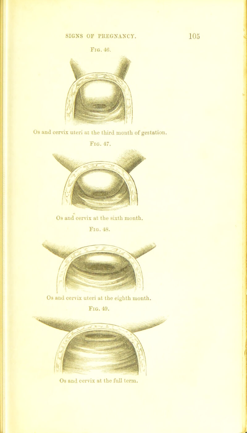 Fig. 46. Os and cervix uteri at the third mouth of gestation. Fig. 47. Os and cervix at the sixth month. Fig. 48. Os and cervix uteri at the eighth month. Fig. 49. Os and cervix at the full term.