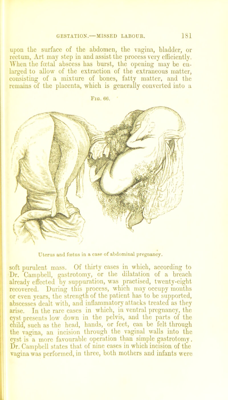 upon the surface of the abdomen, the vagina, bladder, or rectum, Art may step in and assist the process very efficiently. When the foetal abscess has burst, the opening may be en- larged to allow of the extraction of the extraneous matter, consisting of a mixture of bones, fatty matter, and the remains of the placenta, which is generally converted into a Fig. 66. Uterus and fetus in a case of abdominal pregnancy. soft purulent mass. Of thirty cases in which, according to Dr. Campbell, gastrotomy, or the dilatation of a breach already effected by suppuration, was practised, twenty-eight recovered. During this process, which may occupy months or even years, the strength of the patient has to be supported, abscesses dealt with, and inflammatory attacks treated as they arise. In the rare cases in which, in ventral pregnancy, the cyst presents low down in the pelvis, and the parts of the child, such as the head, hands, or feet, can be felt through the vagina, an incision through the vaginal walls into the cyst is a more favourable operation than simple gastrotomy. Dr. Campbell states that of nine cases in which incision of the vagina was performed, in three, both mothers and infants were