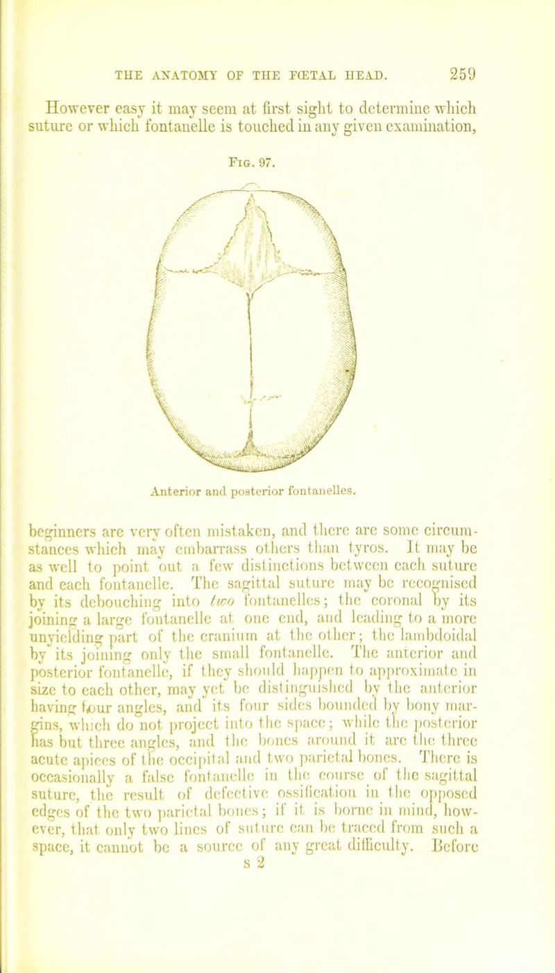 However easy it may seem at first sight to determine which suture or which fontanelle is touched in any given examination, Pig. 97. Anterior and posterior fontanelles. beginners are very often mistaken, and there arc some circum- stances which may embarrass others than tyros. It may be as well to point out a few distinctions between each suture and each fontanelle. The sagittal suture may be recognised by its debouching into tico fontanelles; the coronal by its joining a large fontanelle at one end, and leading to a more unyielding part of the cranium at the other ; the lambdoidal by its joining only the small fontanelle. The anterior and posterior fontanelle, if they should happen to approximate in size to each other, may yet be distinguished by the anterior having hour angles, and its four sides bounded by bony mar- gins, which do not project into the space; while the posterior has but three angles, and the bones around it arc the three acute apices of the occipital and two parietal bones. There is occasionally a false fontanelle in the course oi the sagittal suture, the result of defective ossification in the opposed edges of the two parietal bones; il it is borne in mind, how- ever, that only two lines of suture can be traced from such a space, it cannot be a source of any great difficulty. Before