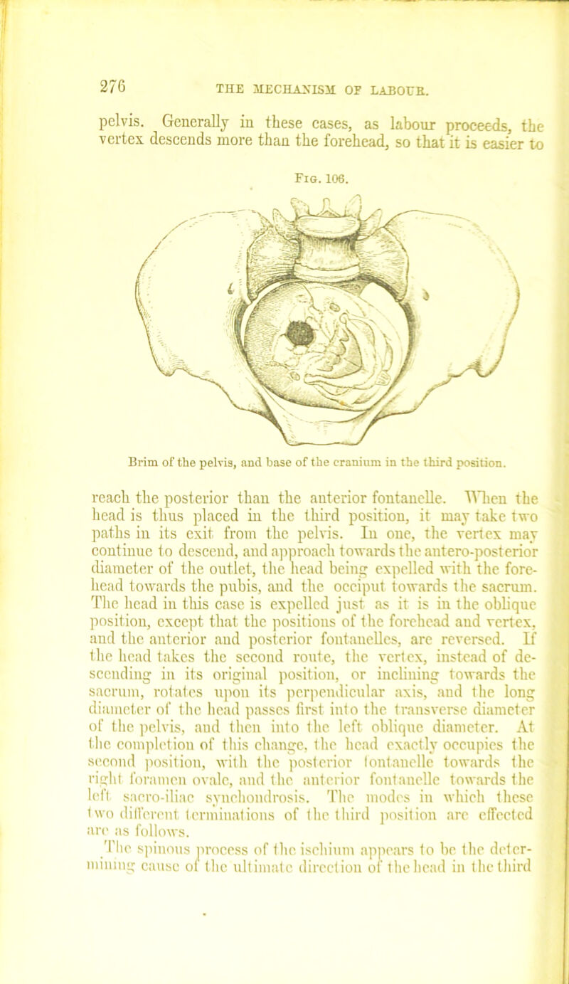 pelvis. Generally in these cases, as labour proceeds, the vertex descends more than the forehead, so that it is easier to Fig. 106. Brim of the pelvia, and base of the cranium in the third position. reach the posterior than the anterior fontanelle. When the head is thus placed in the third position, it may take two paths in its exit from the pelvis. In one, the vertex may continue to descend, and approach towards the antero-posterior diameter of the outlet, the head being expelled with the fore- head towards the pubis, and the occiput towards the sacrum. The head in this case is expelled just as it is in the oblique position, except that the positions of the forehead and vertex, and the anterior and posterior fontanelles, are reversed. If the head takes the second route, the vertex, instead of de- scending in its original position, or inclining towards the sacrum, rotates upon its perpendicular axis, and the long diameter of the head passes first into the transverse diameter of the pelvis, and then into the left oblique diameter. At the completion of this change, the head exactly occupies the second position, with the posterior lontanelle towards the right foramen ovale, and the anterior fontanelle towards the left sacro-iliac synchondrosis. The modes in which these two different terminations of the third position arc effected are as follows. The spinous process of the ischium appears to be the deter- mining cause of the ultimate direction of the head in the third