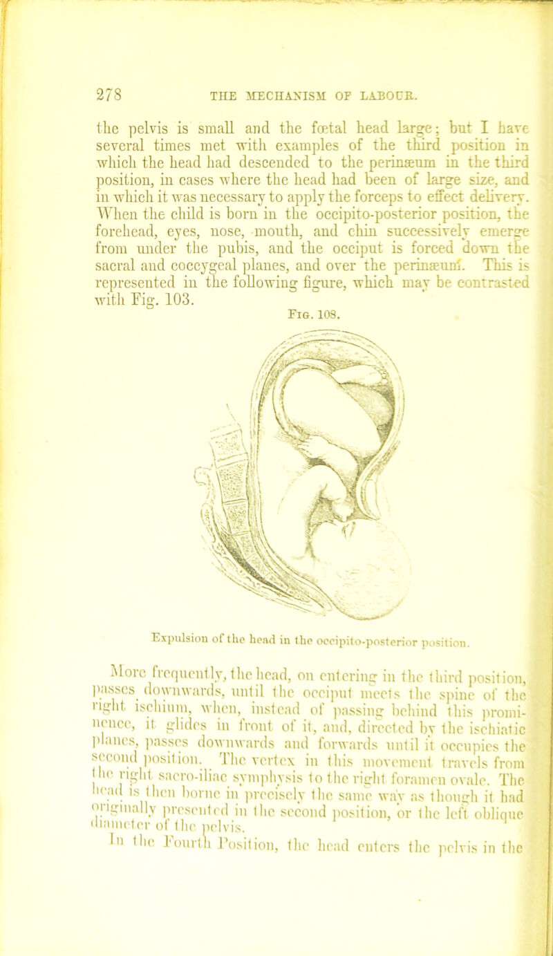 the pelvis is small and the fcetal head large; but I have several times met with examples of the third position in which the head had descended to the perinamm in the third position, in cases where the head had been of large size, and in which it was necessary to apply the forceps to effect delivery. When the child is born in the occipito-posterior position, the forehead, eyes, nose, mouth, and chin successively emerge from under the pubis, and the occiput is forced down the sacral and coccygeal planes, and over the perimeuri. This is ■ represented in the following figure, which may be contrasted with Fig. 103. Fig. 109. Expulsion of the head in the occipito-posterior position. More frequently, the head, on entering in the third position, ] passes downwards, until the occiput meets the spine of the 1 ilolit, ischium, when, instead ol passing behind this promi- ^ nence, it glides in front of it, and, directed by the isehiatic ! planes, passes downwards and forwards until it occupies the ? second position. The vertex in this movement travels from • lie right, sacro-iliac symphysis to the right foramen ovale. The •■ad is then borne in precisely the same way as though it had originally presented in tlie second position, or the left oblique diameter of the pelvis. In the Fourth Position, the head enters the pelvis in the