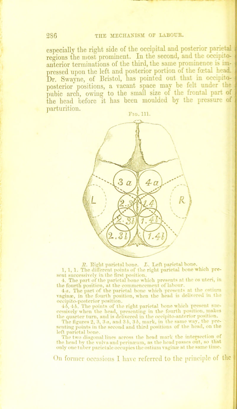 especially the right side of the occipital and posterior parietal regions the most prominent. In the second, and the occipito- anterior terminations of the third, the same prominence is im- pressed upon the left and posterior portion of the fcetal head. Dr. Swayne, of Bristol, has pointed out that in occipito- posterior positions, a vacant space may be felt under the pubic arch, owing to the small size ol the frontal part of the head before it has been moulded by the pressure of parturition. Fig.111. 7?. Fight parietal bone. L. Loft parietal bone. 1, 1, 1. The different points of the right parietal bone which pre- sent successively in the first position. 4. The part of the parietal bone which presents at the os uteri, in the fourth position, at the commencement of labour. 4<7. The part of the parietal bone which presents at the ostium vagina?, in the fourth position, when the head is delivered in the occipit o-post erior posit ion. 4o, 4ft. The points of the right parietal bone which present suc- cessively when the head, presenting in the fourth position, makes the quarter turn, and is delivered in the occipito-anterior position. The figures 2, 3, 3a, and 3 b, 3 b, mark, in the same way, the pre- senting points in the second and third positions of the head, on the left parietal bone. The two diagonal lines across the head mark the intersection of the head by the vulva and perinn?uin, as the head passes out, so that only one t uber parietale occupies the ostium vagina? at the same time.