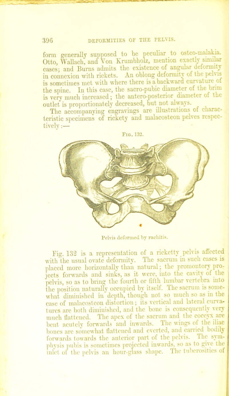 form generally supposed to be peculiar to osteo-iualakia. Otto, Wallach, and Von Krumbholz, mention exactly similar cases; and Bums admits the existence of angular deformity in connexion with rickets. An oblong deformity of the pehis is sometimes met with where there is a backward curvature of the spine. In this case, the sacro-pubic diameter of the brim is very much increased; the antero-posterior diameter of ihe outlet is proportionately decreased, but not always. The accompanying engravings are illustrations of charac- teristic specimens of rickety and malacosteon pelves respec- tively :— Fig.132. Pelvis deformed by rachitis. Fig. 132 is a representation of a rickctty pelvis affected with the usual ovate deformity. The sacrum in such cases is placed more horizontally than natural; Ihe promontory pro- jects forwards and sinks, as it were, into the cavity of the pelvis, so as to bring the fourth or fifth lumbar vertebra into the position naturally occupied by itself. The sacrum is some- what diminished in depth, though not so much so as in the case of malacosteon distortion; its vertical and lateral curva- tures are both diminished, and the bone is consequently very much flattened. The apex of the sacrum and the coccyx are bent acutely forwards and inwards. The wings of the iliac bones arc somewhat flattened and everted, and carried bodily- forwards towards the anterior part of the pelvis. Ihe sym- physis pubis is sometimes projected inwards, so as to give the inlet of the pelvis an hour-glass shape. The tuberosities of