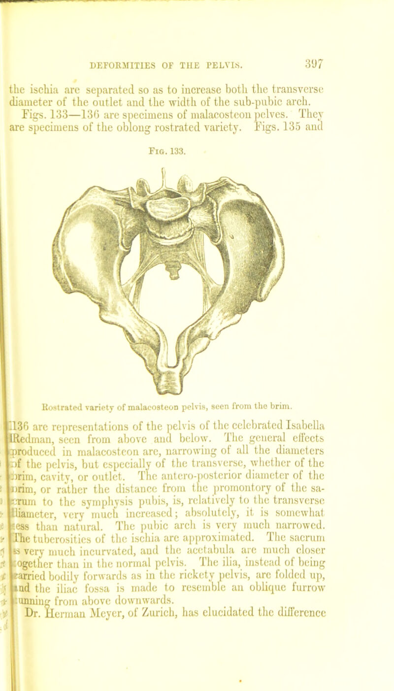 the ischia are separated so as to increase both the transverse diameter of the outlet and the width of the sub-pubic arch. Figs. 133—136 are specimens of malacosteon pelves. They are specimens of the oblong rostrated variety. Figs. 135 and Fi&. 133. Hostrated variety of malacosteon pelvis, seen from the brim. 136 are representations of the pelvis of the celebrated Isabella HRedrnan, seen from above and below. The general effects produced in malacosteon arc, narrowing of all the diameters : pf the pelvis, but especially of the transverse, whether of the prim, cavity, or outlet. The antcro-posterior diameter of the : prim, or rather the distance from the promontory of the sa- > Turn to the symphysis pubis, is, relatively to the transverse • lliameter, very much increased; absolutely, it is somewhat i 'ess than natural. The pubic arch is very much narrowed. • The tuberosities of the ischia are approximated. The sacrum 5 is very much incurvated, and the acetabula are much closer if together than in the normal pelvis. The ilia, instead of being c rarried bodily forwards as in the rickety pelvis, arc folded up, jj ind the iliac fossa is made to resemble an oblique furrow t tunning from above downwards. ■j? Dr. Herman Meyer, of Zurich, has elucidated the difference