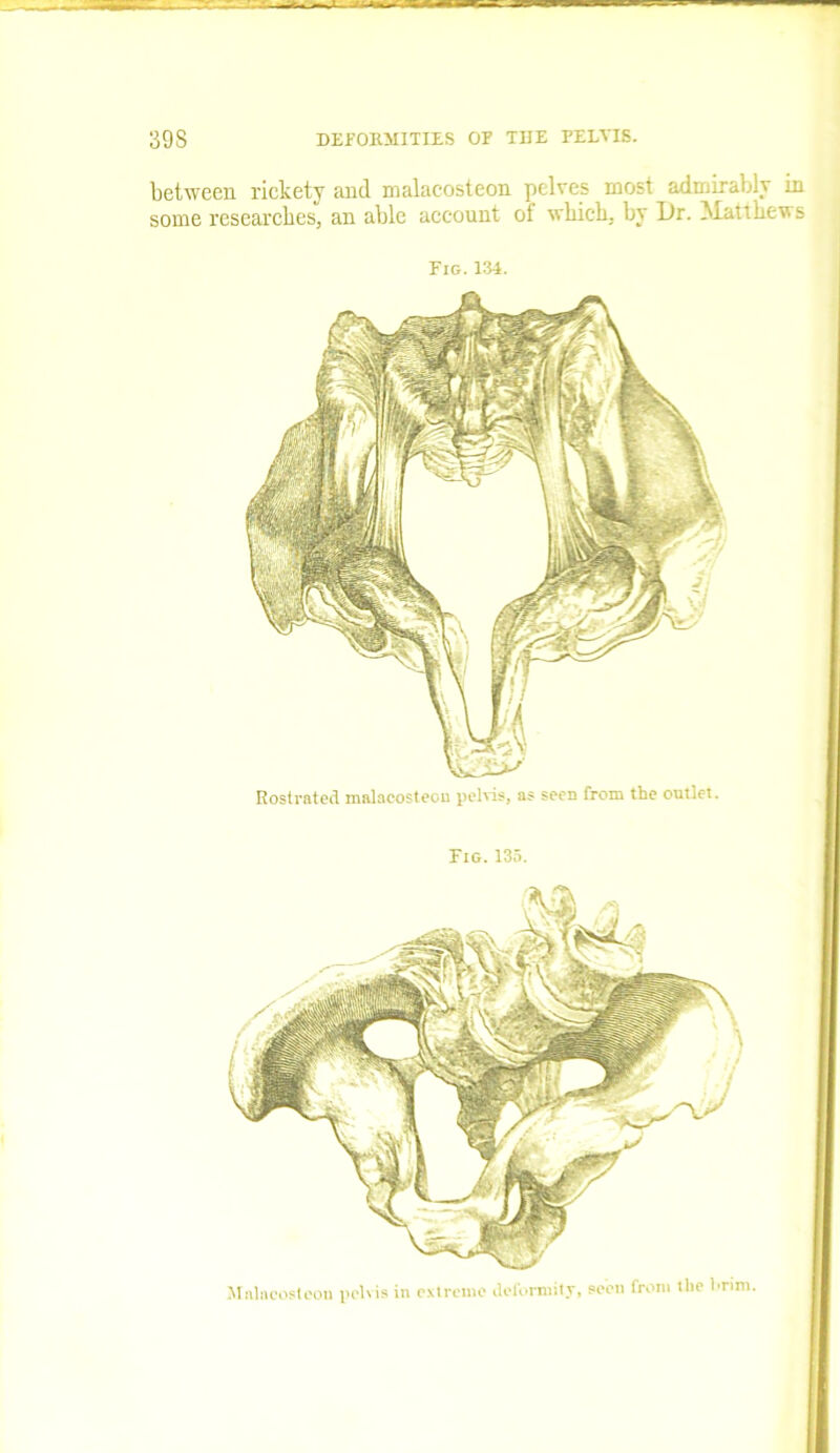 between rickety and malacosteon pelves most admirably in some researches, an able account of which, by Dr. Matthews Fig. 134. Rostrated malacosteon pelvis, as seen from the outlet. Fig. 135. Malacosteon pelvis in extreme deformity, seen from the brim