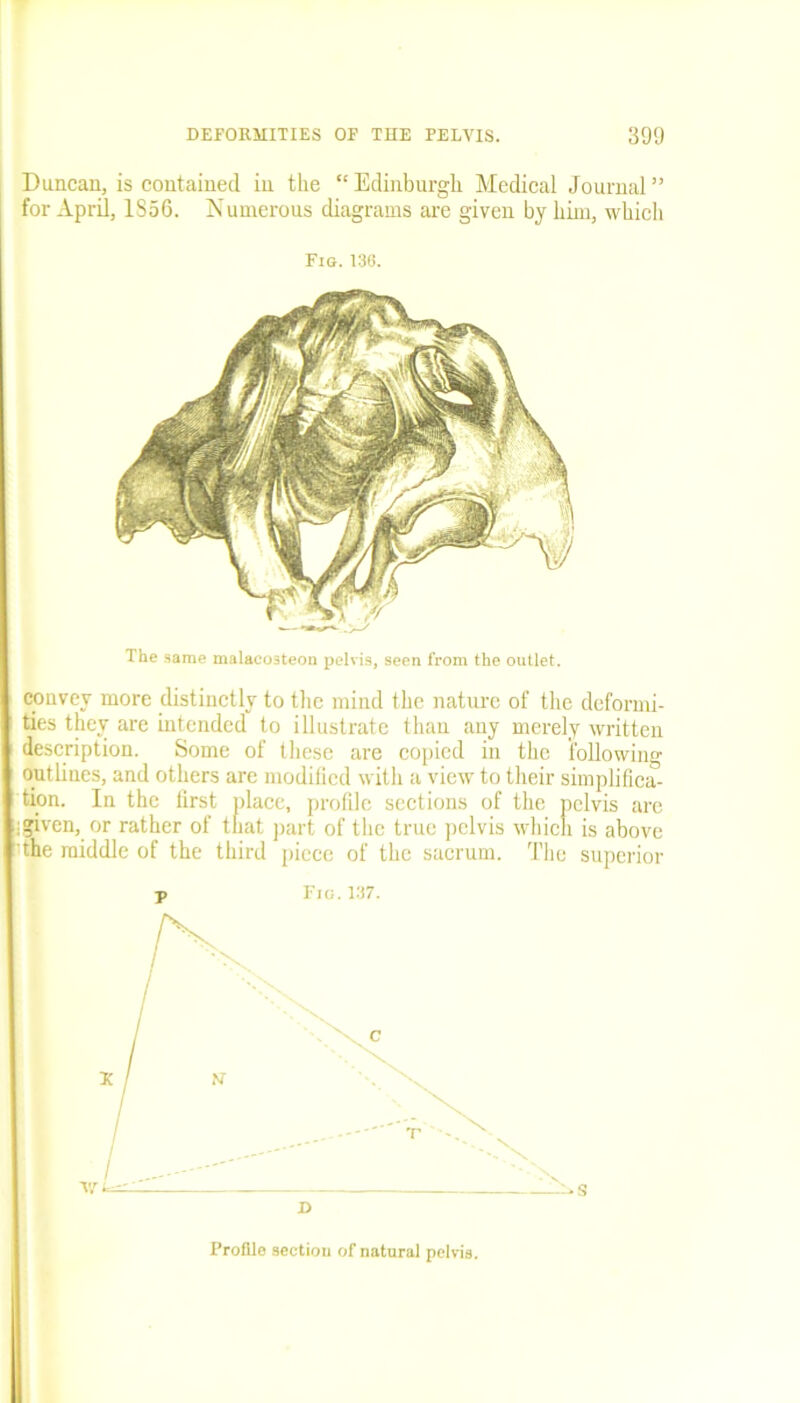 Duncan, is contained in the “Edinburgh Medical Journal” for April, 1356. Numerous diagrams are given by him, which Fig. 136. The same malacosteon pelvis, seen from the outlet. convey more distinctly to the mind the nature of the deformi- ties they are intended to illustrate than any merely written description. Some of these are copied in the following outlines, and others arc modified with a view to their simplifica- tion. In the first place, profile sections of the pelvis are igiven, or rather of that part of the true pelvis which is above the middle of the third piece of the sacrum. The superior p Fig.137. D Profile section of natural pelvis.