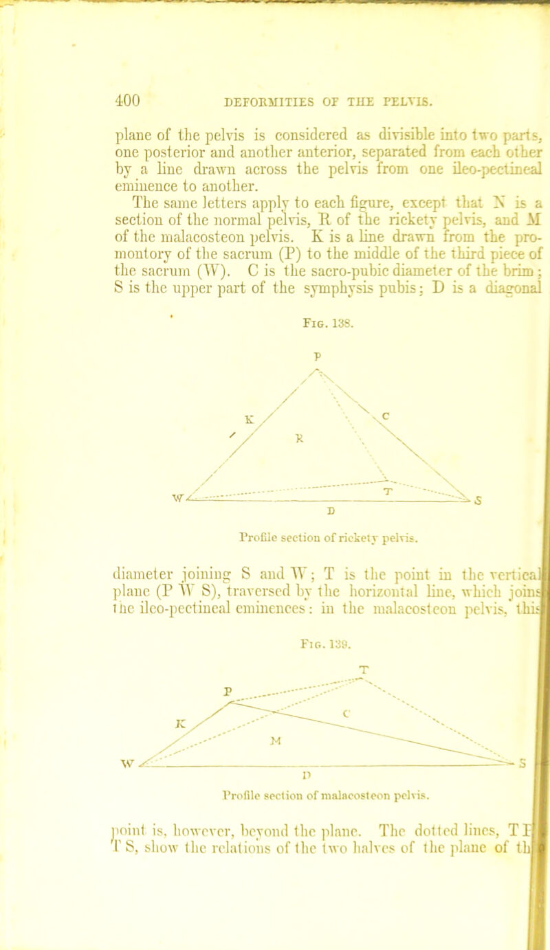 plane of the pelvis is considered as divisible into two parts, one posterior and another anterior, separated from each other by a line drawn across the pelvis from one ileo-pectineal eminence to another. The same letters apply to each figure, except that N is a section of the normal pelvis, R. of the rickety pelvis, and M of the malacosteon pelvis. K is a line drawn from the pro- montory of the sacrum (P) to the middle of the third piece of the sacrum (W). C is the sacro-pubic diameter of the brim: S is the upper part of the symphysis pubis: D is a diagonal Fig. 138. P Profile section of rickety pelvis. diameter joining S and TV; T is the point in the vertical plane (P TV S), traversed by the horizontal line, which join the ileo-pectineal eminences: in the malacosteon pelvis, tJ' Fig. 139. Profile section of malacosteon pelvis. point is, however, beyond the plane. The dotled lines. Til T S, show the relations of the two halves of the plane of thl