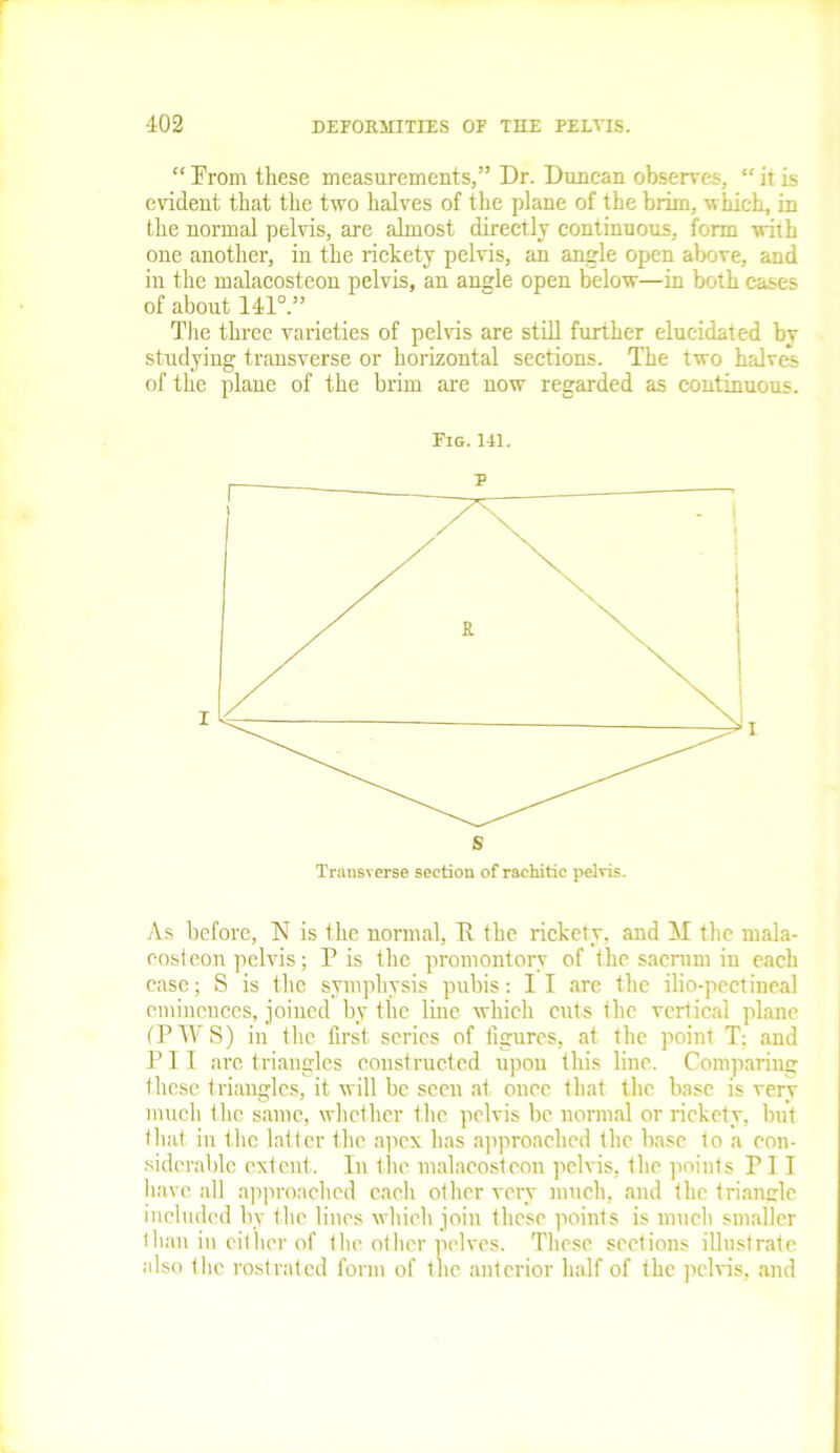 “ From these measurements,” Dr. Duncan observes, “ it is evident that the two halves of the plane of the brim, which, in the normal pelvis, are almost directly continuous, form with one another, in the rickety pelvis, an angle open above, and in the malacosteon pelvis, an angle open below—in both cases of about 111°.” The three varieties of pelvis are still further elucidated by studying transverse or horizontal sections. The two halves of the plane of the brim are now regarded as continuous. Fig.141. Transverse section of rachitic pelvis. As before, N is the normal, T\ the rickety, and M the mala- costeon pelvis; P is the promontory of the sacrum in each case; S is the symphysis pubis: II arc the ilio-pectineal eminences, joined by the line which cuts the vertical plane (TWS) in the first series of figures, at the point T: and P11 are triangles constructed upon this line. Comparing these triangles, it will he seen at once that the base is very much the same, whether the pelvis be normal or rickety, but that in the latter the apex has approached the base to a con- siderable extent. In the malacosteon pelvis, the points Til have all approached each other very much, and the triangle included by the lines which join these points is much smaller than in either of the other pelves. These sections illustrate also the rostrated form of tlie anterior half of the pelvis, and