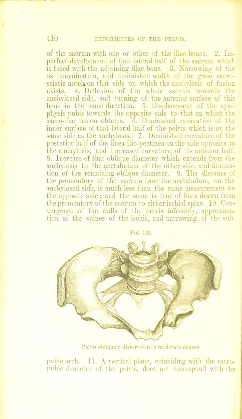 of the sacrum with one or other of the iliac bones. 2. Im- perfect development of that lateral half of the sacrum which is fused with the adjoining iliac bone. 3. Narrowing of the os innominatum, and diminished width of the great sacro- sciatic notch, on that side on which the anchylosis of fusion exists. 1. Deflexion of the whole sacrum towards the anchylosed side, and turning of the anterior surface of this bone in the same direction. 5. Displacement of the sym- physis pubis towards the opposite side to that on which the sacro-iliac fusion obtains. 6. Diminished excavation of the inner surface of that lateral half of the pelvis which is on the same side as the anchylosis. 7. Diminished curvature of the posterior half of the linea ilio-pectinea on the side opposite to the anchylosis, and increased curvature of its anterior half. 8. Increase of that oblique diameter which extends from the anchylosis to the acetabulum of the other side, and diminu- tion of the remaining oblique diameter. 9. The distance of the promontory of the sacrum from the acetabulum, on the anchylosed side, is much less than the same measurement on the opposite side; and the same is true of lines drawn from the promontory of the sacrum to either ischial spine. 10. Con- vergence of the walls of the pelvis interiorly, approxima- tion of the spines of the ischia, and narrowing of the sub- Fig. 143. Pelvis obliquely distorted to a moderate degree. pubic arch. 11. A vertical plane, coinciding with the sacro- I pubic diameter of the pelvis, does not correspond with the I