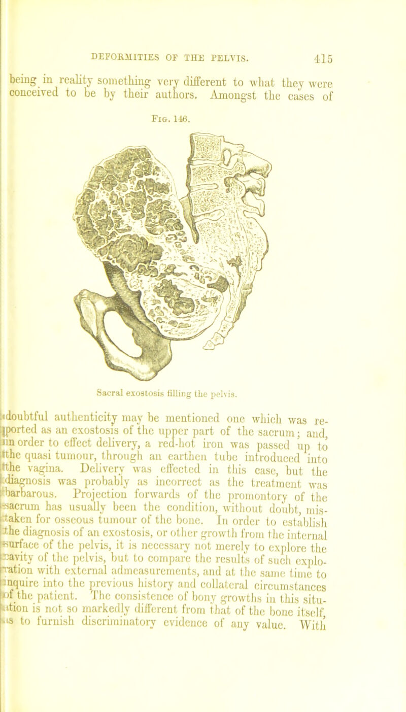 being in reality something very different to what they were conceived to be by their authors, Amongst the cases of Fig. 146. Sacral exostosis filling the pelvis. [(doubtful authenticity may be mentioned one which was re- ported as an exostosis of the upper part of the sacrum; and, lin order to effect delivery, a red-hot iron was passed up to »the quasi tumour, through an earthen tube introduced into tthe vagina. Delivery was effected in this ease, but the ediagnosis was probably as incorrect as the treatment was •barbarous. Projectiou forwards of the promontory of the ■sacrum has usually been the condition, without doubt, mis- taken for osseous tumour of the bone. In order to establish the diagnosis of an exostosis, or other growth from the internal surface of the pelvis, it is necessary not merely to explore the navity of the pelvis, but to compare the results of such explo- ration with external admeasurements, and at the same time to inquire into the previous history and collateral circumstances nf the patient. The consistence of bony growths in this situ- ation is not so markedly different from that of the bone itself '‘3 to furnish discriminatory evidence of any value. With