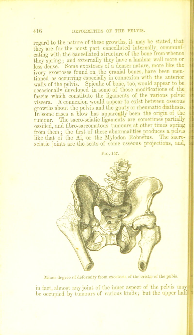 regard to the nature of these growths, it may be stated, that they are for the most part cancellated internally, communi- cating with the cancellated structure of the bone from whence they spring; and externally they have a laminar wall more or less dense. Some exostoses of a denser nature, more like the ivory exostoses found on the cranial bones, have been men- tioned as occurring especially in connexion with the anterior walls of the pelvis. Spiculce of bone, too, would appear to be occasionally developed in some of those modifications of the fascia which constitute the ligaments of the various pelvic viscera. A connexion would appear to exist between osseous growths about the pelvis and the gouty or rheumatic diathesis. In some cases a blow has apparently been the origin of the tumour. The sacro-sciatic ligaments are sometimes partially ossified, and fibro-sarcomatous tumours at other times spring from them ; the first of these abnormalities produces a, pelvis like that of the Ai, or the Mylodon Itobustus. pie sacro- sciatic joints are the seats of some osseous projections, and. Fig. 147. Minor degree of deformity from exostosis of the eristic of the pubis. in fact, almost any joint of the inner aspect of the pelvis may lie occupied by tumours of various kinds; but the upper half