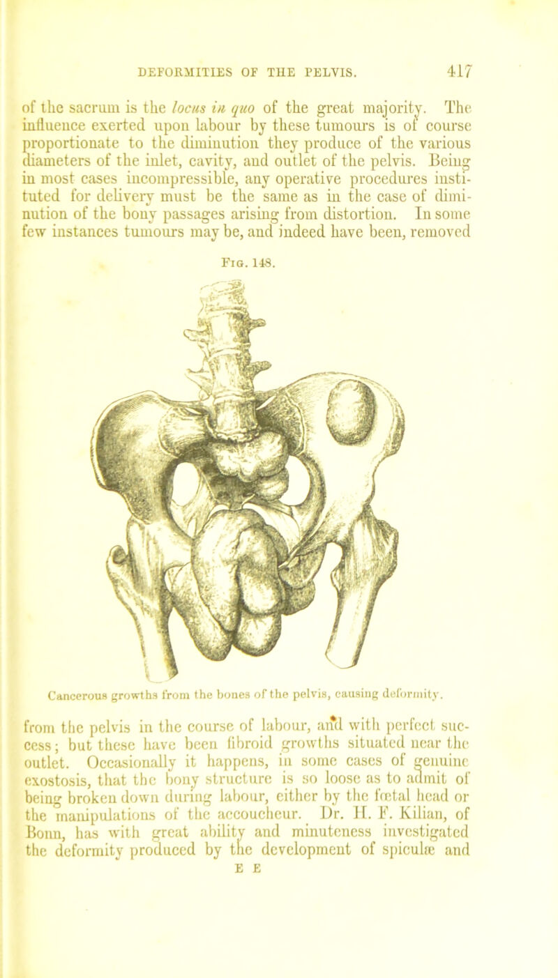of the sacrum is the locus in quo of the great majority. The influence exerted upon labour by these tumours is oi course proportionate to the diminution they produce of the various diameters of the inlet, cavity, and outlet of the pelvis. Being in most cases incompressible, any operative procedures insti- tuted for delivery must be the same as in the case of dimi- nution of the bony passages arising from distortion. In some few instances tumours may be, and indeed have been, removed Fig.148. Cancerous growths from the bones of the pelvis, causing deformity. front the pelvis in the course of labour, and with perfect suc- cess ; but these have been fibroid growths situated near the outlet. Occasiomdly it happens, in some cases of genuine exostosis, that the bony structure is so loose as to admit of being broken down during labour, cither by the foetal head or the manipulations of the accoucheur. Dr. II. F. Kilian, of Boim, has with great ability and minuteness investigated the deformity produced by tfie development of spiculie and E E