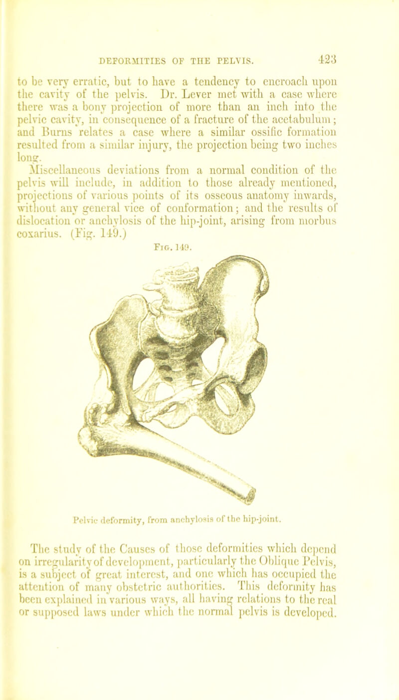 4-2;} to be very erratic, but to have a tendency to encroach upon the cavity of the pelvis. Dr. Lever met with a case where there was a bony projection of more than an inch into the pelvic cavity, in consequence of a fracture of the acetabulum; and Burns relates a case where a similar ossific formation resulted from a similar injury, the projection being two inches long. Miscellaneous deviations from a normal condition of the pelvis will include, in addition to those already mentioned, projections of various points of its osseous anatomy inwards, without any general vice of conformation; and the results of dislocation or anchylosis of the hip-joint, arising from morbus coxarius. (Fig. 149.) Fig.149. Petrie deformity, from anchylosis of the hip-joint. The study of the Causes of those deformities which depend on irregularity of development, particularly the Oblique Pelvis, is a subject of great interest, and one which has occupied the attention of many obstetric authorities. This deformity has been explained in various ways, all having relations to the real or supposed laws under which the nomuil pelvis is developed.