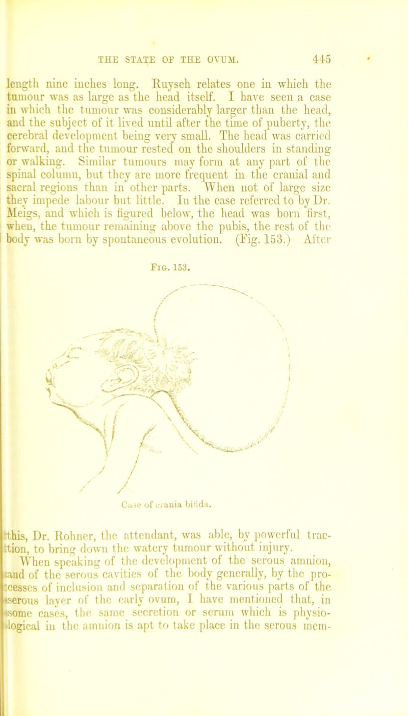 length nine inches long. Ruysch relates one in which the tumour was as large as the head itself. I have seen a case in which the tumour was considerably larger than the head, and the subject of it lived until after the tune of puberty, the cerebral development being very small. The head was carried forward, and the tumour rested on the shoulders in standing or walking. Similar tumours may form at any part of the spinal column, but they are more frequent in the cranial and sacral regions than in other parts. When not of large size they impede labour but little. Iu the case referred to by Dr. Meigs, and which is figured below, the head was born first, when, the tumour remaining above the pubis, the rest of the I body was born by spontaneous evolution. (Tig. 153.) After Fig.153. S' / ( Case of crania birida. rthis, Dr. Rohner, the attendant, was able, by powerful trac- tion, to bring down the watery tumour without injury. When speaking of the development of the serous amnion, land of the serous cavities of the body generally, by the pro- cesses of inclusion and separation of the various parts of the ♦serous layer of the early ovum, I have mentioned that, in ♦some cases, the same secretion or serum which is physio- logical in the amnion is apt to take place in the serous mem-