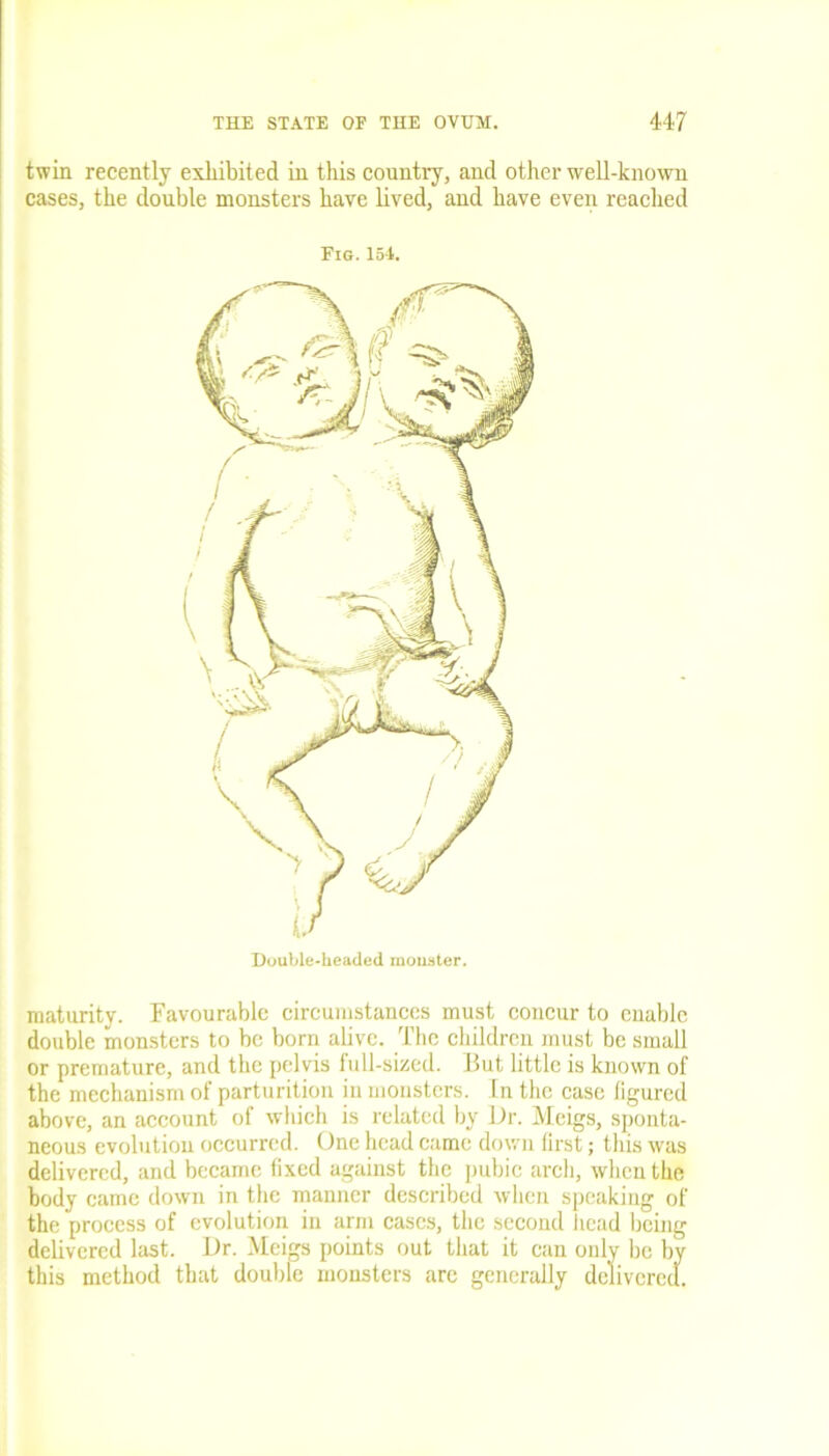 twin recently exhibited in this country, and other well-known cases, the double monsters have lived, and have even reached Fig. 154. maturity. Favourable circumstances must concur to enable double monsters to be born alive. The children must be small or premature, and the pelvis full-sized. But little is known of the mechanism of parturition in monsters. In the case figured above, an account of which is related by Dr. Meigs, sponta- neous evolution occurred. One head came down first; this was delivered, and became fixed against the pubic arch, when the body came down in the manner described when speaking of the process of evolution in arm cases, the second head being delivered last. Dr. Meigs points out that it can only be by this method that double monsters are generally delivered.