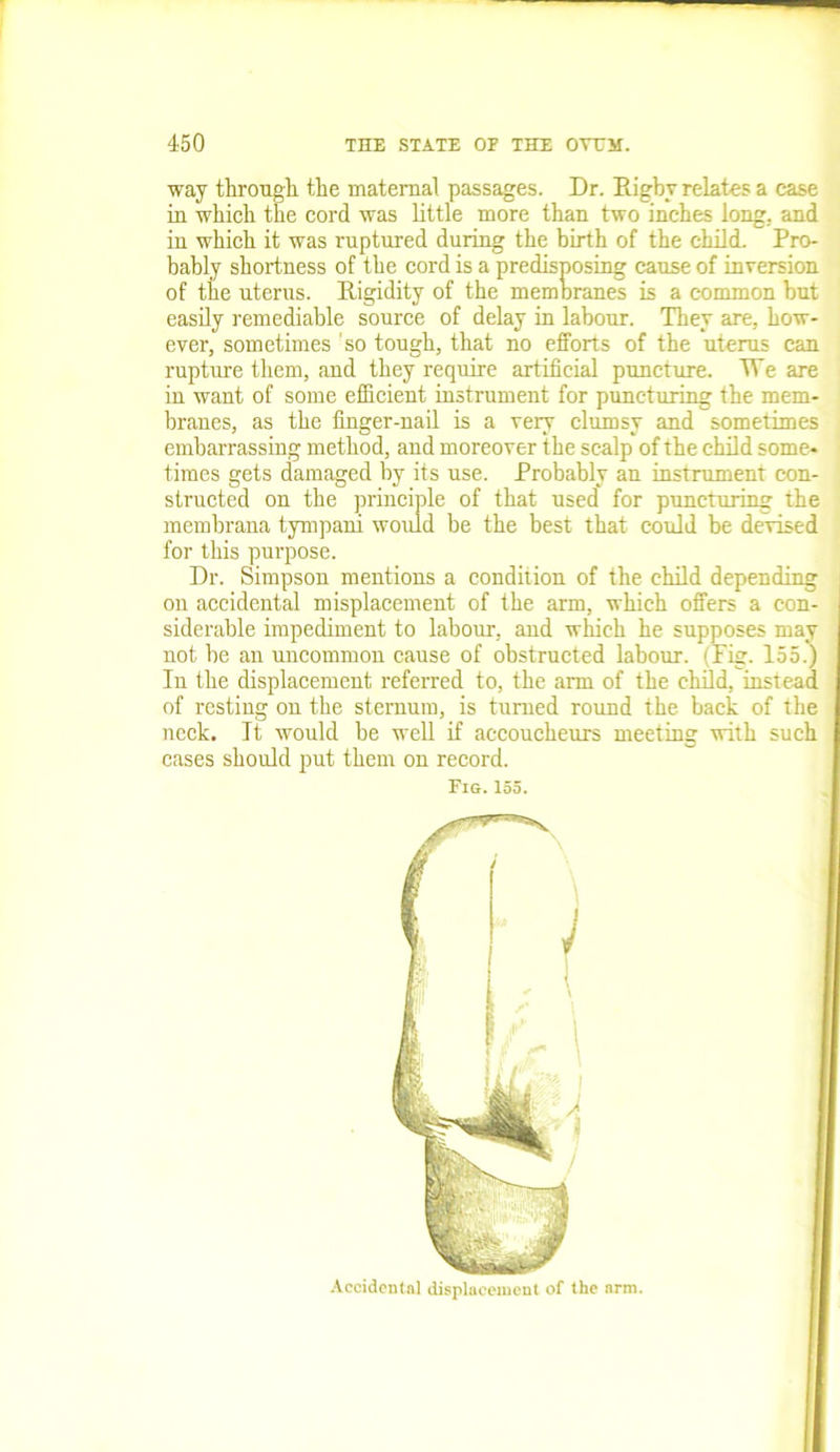 way through the maternal passages. Dr. Rigby relates a case in which the cord was little more than two inches long, and in which it was ruptured during the birth of the child. Pro- bably shortness of the cord is a predisposing cause of inversion of the uterus. Rigidity of the membranes is a common but easily remediable source of delay in labour. They are, how- ever, sometimes so tough, that no efforts of the uterus can rupture them, and they require artificial puncture. TVe are in want of some efficient instrument for puncturing the mem- branes, as the finger-nail is a very clumsy and sometimes embarrassing method, and moreover the scalp of the child some- times gets damaged by its use. Probably an instrument con- structed on the principle of that used* for puncturing the membrana tympani would be the best that could be devised for this purpose. Dr. Simpson mentions a condition of the child depending on accidental misplacement of the arm, which offers a con- siderable impediment to labour, and which he supposes may not be an uncommon cause of obstructed labour. (Pig. 155.) In the displacement referred to, the arm of the child, instead of resting on the sternum, is turned round the back of the neck. It would be well if accoucheurs meeting with such cases should put them on record. Fi&. 155.