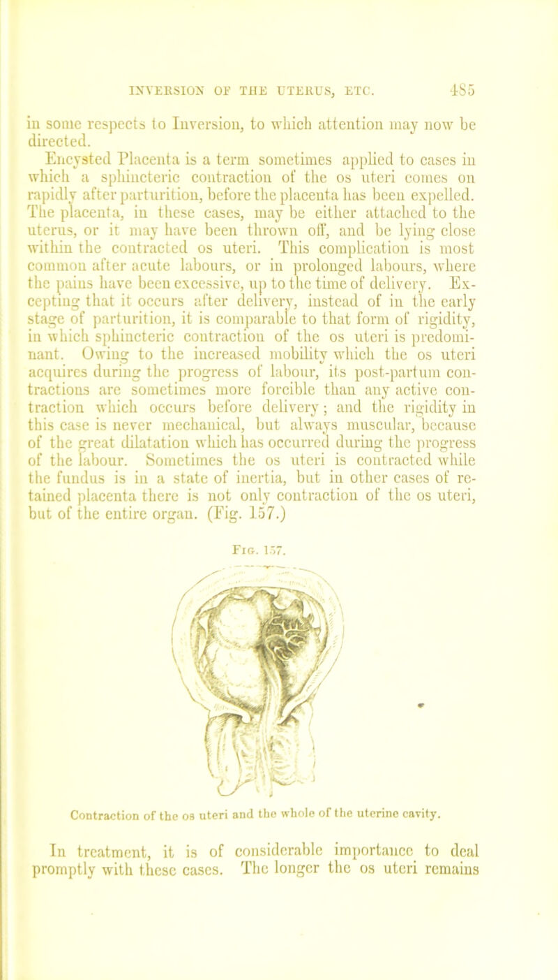 in some respects to Inversion, to which attention may now be directed. Encysted Placenta is a term sometimes applied to cases in which a sphincteric contraction of the os uteri comes on rapidly after parturition, before the placenta has been expelled. The placenta, in these cases, may be either attached to the uterus, or it may have been thrown off, and be lying close within the contracted os uteri. This complication is most common after acute labours, or iu prolonged labours, where the pains have been excessive, up to the tune of delivery. Ex- cepting that it occurs after delivery, instead of in the early stage of parturition, it is comparable to that form of rigidity, in which sphincteric contraction of the os uteri is predomi- nant. Owing to the increased mobility which the os uteri acquires during the progress of labour, its post-partum con- tractions are sometimes more forcible thau any active con- traction which occurs before delivery; and the rigidity in this case is never mechanical, but always muscular, because of the great dilatation which has occurred during the progress of the labour. Sometimes the os uteri is contracted while the fundus is in a state of inertia, but in other cases of re- tained placenta there is not only contraction of the os uteri, but of the entire organ. (Pig. 157.) Contraction of the os uteri and the whole of the uterine cavity. In treatment, it is of considerable importance to deal promptly with these cases. The longer the os uteri remains Fig. 157.