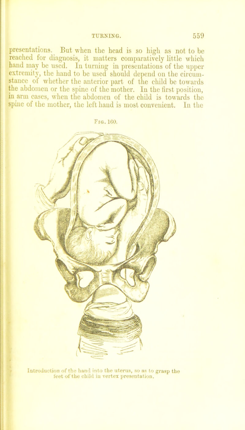 presentations. But when the head is so high as not to be reached for diagnosis, it matters comparatively little which hand may be used. In turning in presentations of the upper extremity, the hand to be used should depend on the circum- stance of whether the anterior part of the child be towards the abdomen or the spine of the mother. In the first position, in arm cases, when the abdomen of the child is towards the spine of the mother, the left hand is most convenient. In the Fig. 160. Introduction of the hand into the uterus, so as to grasp tbo lcet of the child in vertex presentation.