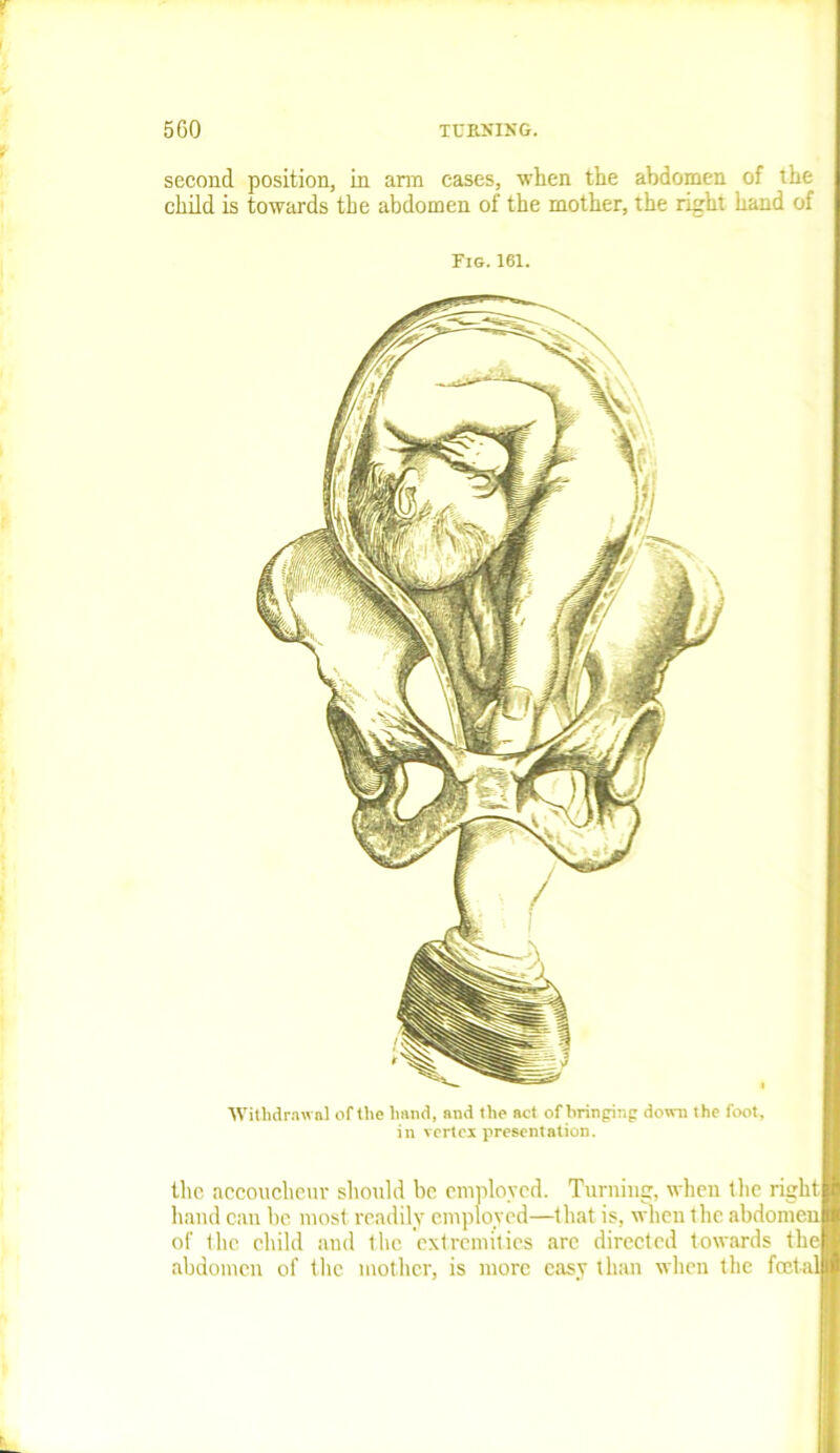 second position, in arm cases, when the abdomen of the child is towards the abdomen of the mother, the right hand of Fig. 161. Withdrawal of the hand, and the act of bringing down the foot, in vertex presentation. the accoucheur should be employed. Turning, when the right hand can he most readily employed—that is, when the abdomen of the child and the, extremities are directed towards thel abdomen of the mother, is more easy than when the foetal