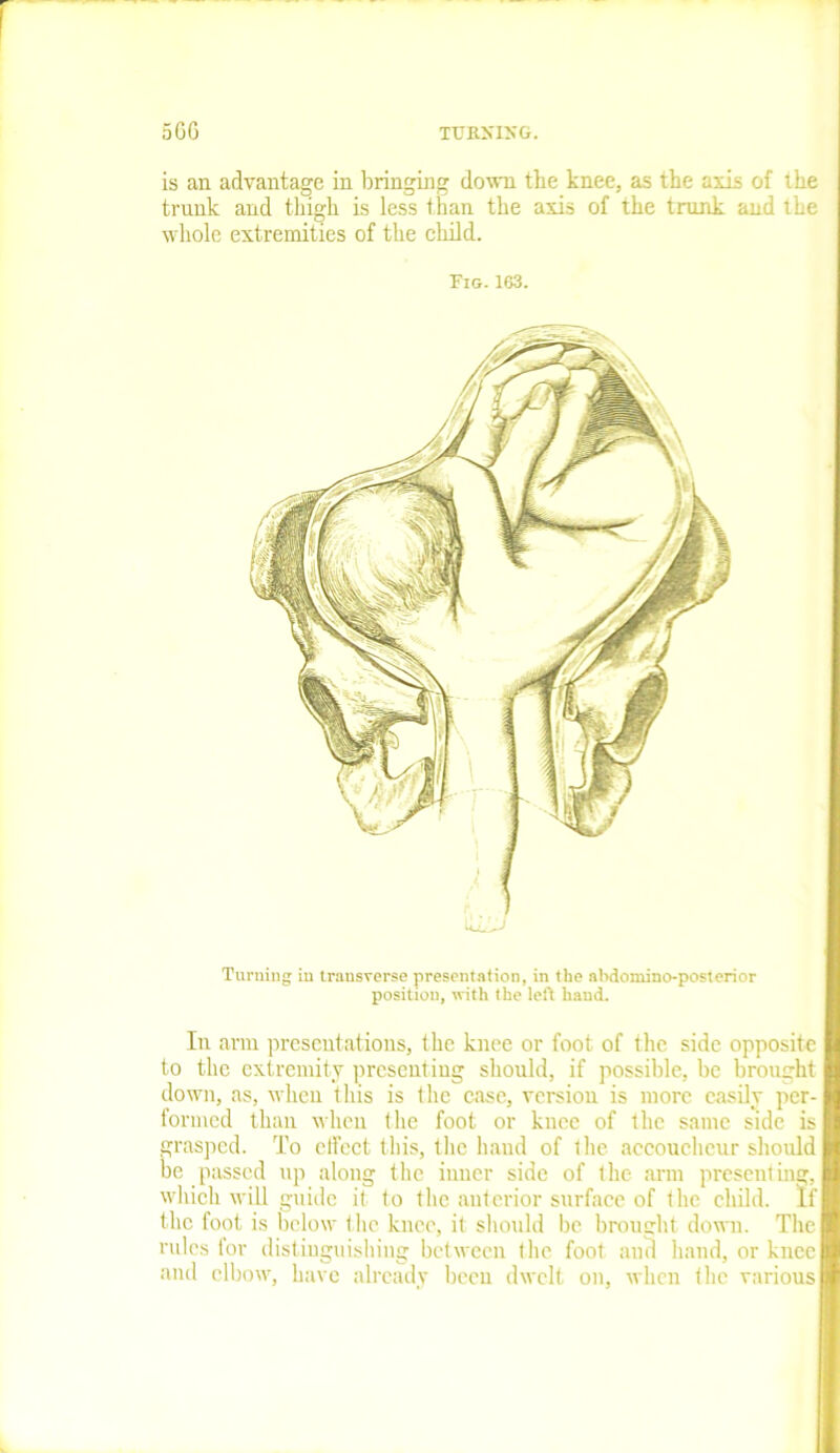 is an advantage in bringing down the knee, as the axis of the trunk and thigh is less than the axis of the trunk and the whole extremities of the child. Pig. 103. Turning in trausverse presentation, in the abdomino-posterior position, with the left hand. In arm presentations, the knee or foot of the side opposite to the extremity presenting should, if possible, be brought down, as, when this is the case, version is more easily per- formed than when the foot or knee of the same side is grasped. To effect this, 1 lie hand of tlie accoucheur should be passed up along the inner side of the arm presenting, which will guide it to the anterior surface of the child. If the foot is below the knee, it should be brought down. The rules for distinguishing between the foot and hand, or knee and elbow, have already been dwelt on, when (lie various