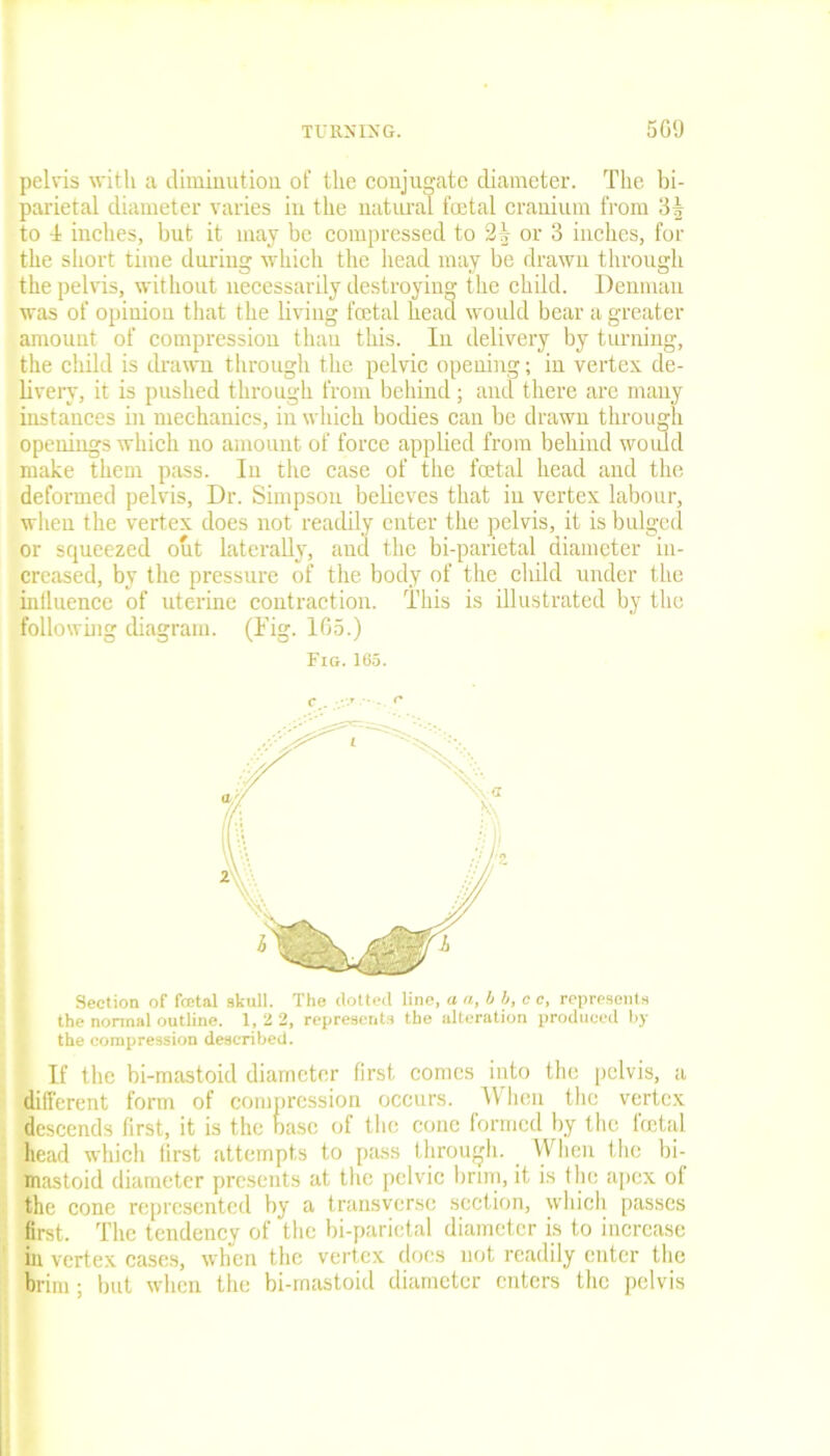 pelvis with a diminution of the conjugate diameter. The bi- parietal diameter varies in the natural foetal cranium from 3| to 1 inches, but it may be compressed to 21- or 3 inches, for the short time during which the head may be drawn through the pelvis, without necessarily destroying the child. Denman was of opinion that the living fcetal head would bear a greater amount of compression than this. In delivery by turning, the child is drawn through the pelvic opening; in vertex, de- livery, it is pushed through from behind; and there are many instances in mechanics, in which bodies can be drawn through openings which no amount of force applied from behind would make them pass. In the case of the foetal head and the deformed pelvis, Dr. Simpson believes that in vertex labour, when the vertex does not readily enter the pelvis, it is bulged or squeezed out laterally, and the bi-parietal diameter in- creased, by the pressure of the body of the cliild under the influence of uterine contraction. This is illustrated by the following diagram. (Tig. 165.) Fig.165. Section of fcetal skull. The dotted line, a a, b b, c c, represents the normal outline. 1, 2 2, represents the alteration produced by the compression described. If the bi-mastoid diameter first comes into the pelvis, a different form of compression occurs. IV lieu the vertex descends first, it is the base of the cone formed by the foetal head which first attempts to pass through. When the bi- mastoid diameter presents at the pelvic brim, it is the apex of the cone represented by a transverse section, which passes first. The tendency of the bi-parietal diameter is to increase in vertex cases, when the vertex does not readily enter the brim; but when the bi-mastoid diameter enters the pelvis