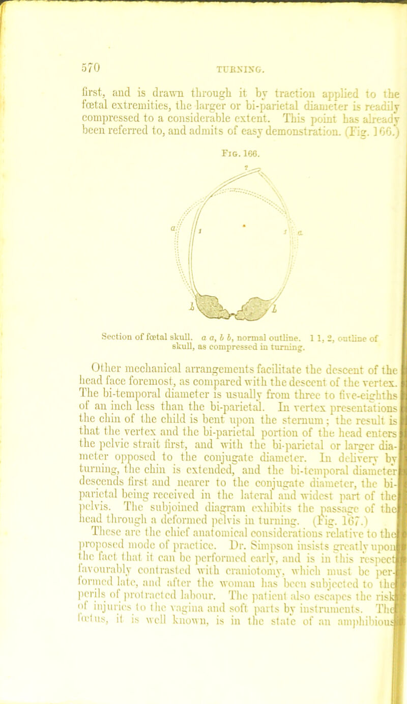 first, and is drawn through it by traction applied to the fetal extremities, the larger or bi-parietal diameter is readily compressed to a considerable extent. This point has already been referred to, and admits of easy demonstration. (Fig. ] 66.) Fig.166. Section of fcetal skull, a a, b b, normal outline. 1 1, 2, outline of skull, as compressed in turning. Other mechanical arrangements facilitate the descent of the I head face foremost, as compared with the descent of the vertex. The bi-temporal diameter is usually from three to five-eighths of an inch less than the bi-parietal. In vertex presentations the chin of the child is bent upon the sternum; the result is that the vertex and the bi-parietal portion of the head enters I the pelvic strait first, and with the bi-parietal or larger dia-| meter opposed to the conjugate diameter. In delivery bvl turning, the chin is extended, and the bi-temporal diameter! descends first and nearer to the conjugate diameter, the bi-f parietal being received in the lateral and widest part of the! pelvis. The subjoined diagram exhibits the passage of the* head through a deformed pelvis in turning. (Fig. 167.) . These arc the chief anatomical considerations relative to theJ proposed mode of practice. Dr. Simpson insists greatly upon! the fact that it can be performed early, and is in this respect (avourably contrasted with craniotomy, which must be per-j formed late, and after the woman has been subjected to the perils of protracted labour. The patient also escapes ihc risk ot injuries to the vagina and soft parts by instruments. The fetus, it is well known, is in the state of an amphibious