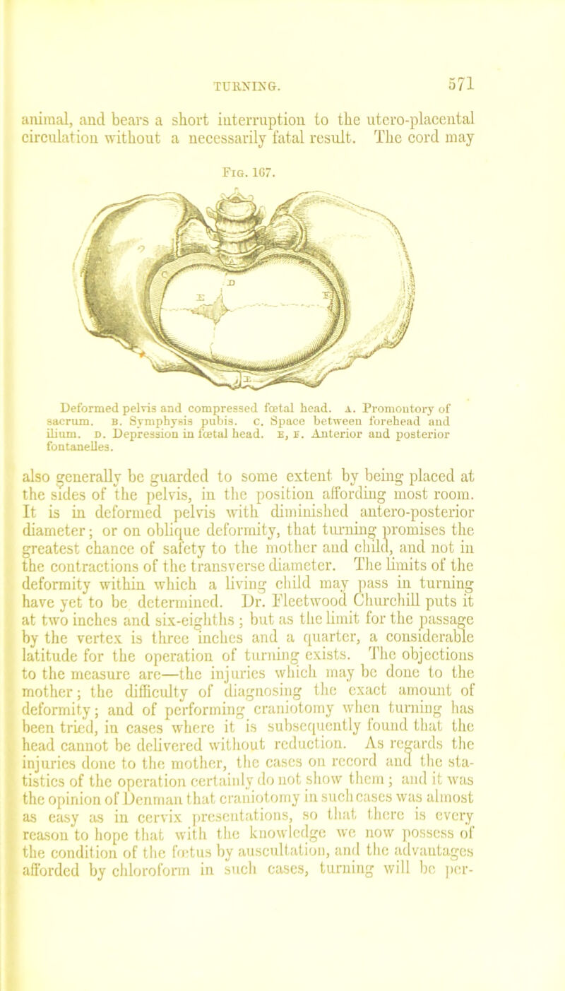 animal, and bears a short interruption to the utero-placental circulation without a necessarily fatal result. The cord may Fig. 1G7. Deformed pelvis and compressed fcetal head. a. Promontory of sacrum. b. Symphysis pubis, c. Space between forehead and ilium, d. Depression in fcetal head, e, u. Anterior and posterior fontanelles. also generally be guarded to some extent by being placed at the sides of the pelvis, in the position affording most room. It is in deformed pelvis with diminished antero-posterior I diameter; or on oblique deformity, that turning promises the greatest chance of safety to the mother and child, and not in the contractions of the transverse diameter. The limits of the deformity within which a living child may pass in turning have yet to be determined. Dr. Fleetwood Churchill puts it at two inches and six-eighths ; but as the limit for the passage by the vertex is three inches and a quarter, a considerable latitude for the operation of turning exists. The objections to the measure arc—the injuries which may be done to the mother; the difficulty of diagnosing the exact amount of deformity; and of performing craniotomy when turning has been tried, in cases where it is subsequently lound that the head cannot be delivered without reduction. As regards the injuries done to the mother, the cases on record and the sta- tistics of the operation certainly do not show them; and it was the opinion of Denman that craniotomy in such cases was almost as easy as in cervix presentations, so that there is every j reason to hope that with the knowledge we now possess of the condition of the fret us by auscultation, and the advantages afforded by chloroform in such cases, turning will be per-