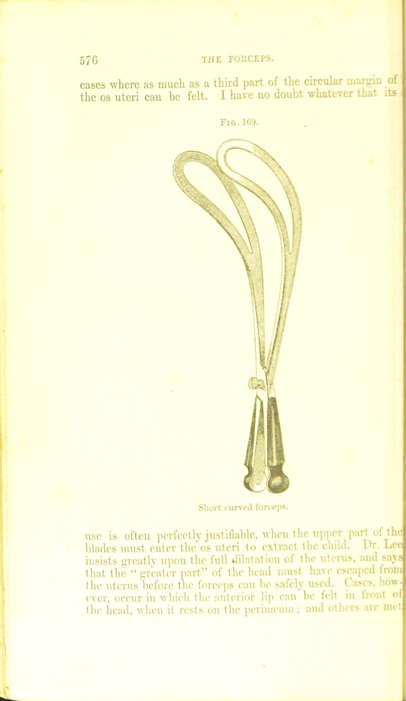 cases where as much as a third part of the circular niaigin of the os uteri can be felt. I have no doubt u hatcver that its Fig. 169. use is often perfectly justifiable, when the upper part of the blades must, enter the os uteri to extract the child. Dr. Lee insists eyently upon ihc full dilatation ol the uterus, and says that the “ greater part” of the head must have escaped from the uterus before the foreeps can be safely used. ( uses, how- ever, occur in which the anterior lip can be felt in front oi the head, when it rests on the perina-um ; and others are met