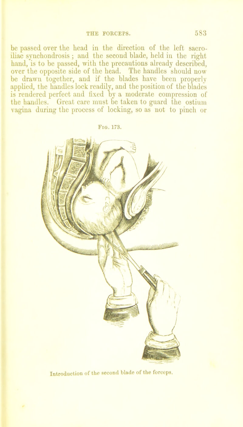 be passed over the head in the direction of the left sacro- iliac synchondrosis ; and the second blade, held in the right hand, is to be passed, with the precautions already described, over the opposite side of the head. The handles should now be drawn together, and if the blades have been properly applied, the handles lock readily, and the position of the blades is rendered perfect and fixed by a moderate compression of the handles. Great care must be taken to guard the ostium vagina during the process of locking, so as not to pinch or Fig.173. Introduction of the second blade of the forceps.