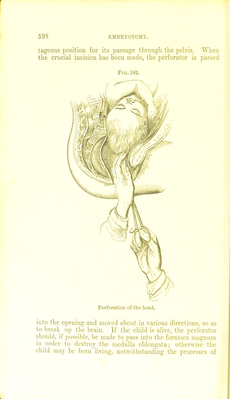 tageous position for its passage through the pelvis. When the crucial incision has been made, the perforator is passed Fig. 182. into the opening and moved about in various directions, so as to break up the brain. If the child is alive, the perforator should, if possible, be made to pass into the foramen magnum in order to destroy the medulla oblongata; otherwise the child may be born living, notwithstanding the processes of Perforation of the head.